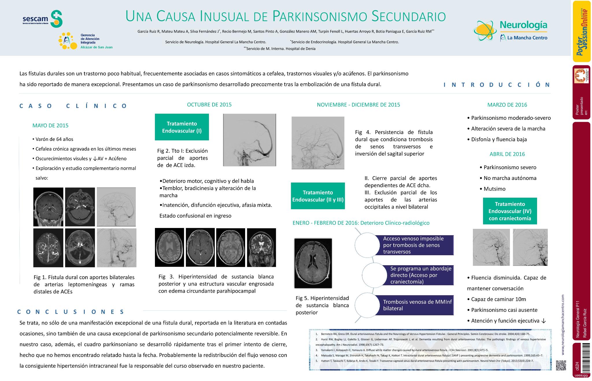 Una causa inusual de parkinsonismo secundario