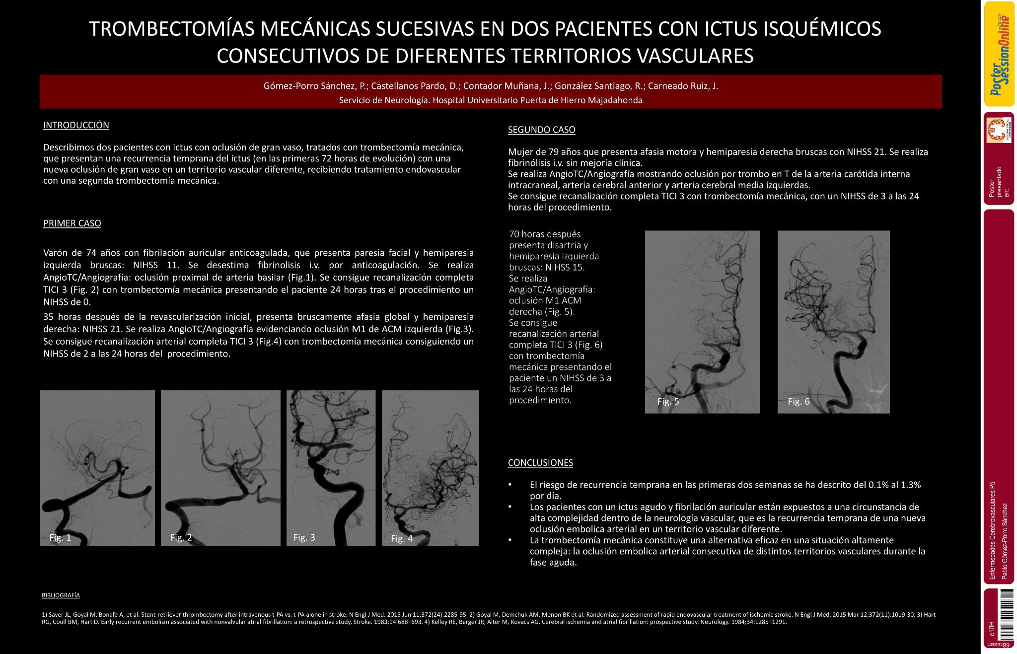 Trombectomías mecánicas sucesivas en dos pacientes con ictus isquémicos consecutivos de diferentes territorios vasculares