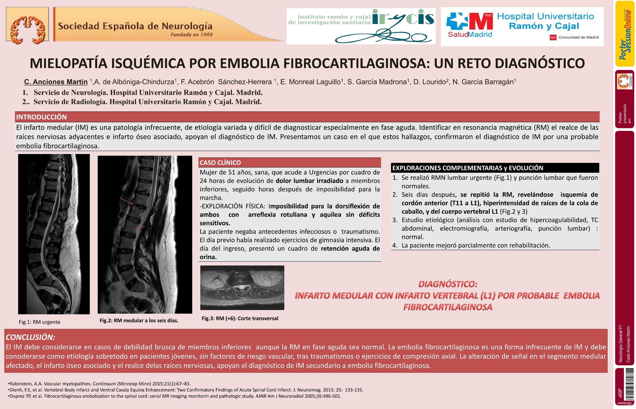 Embolia fibrocartilaginosa: una causa infrecuente de mielopatía isquémica y difícil diagnóstico
