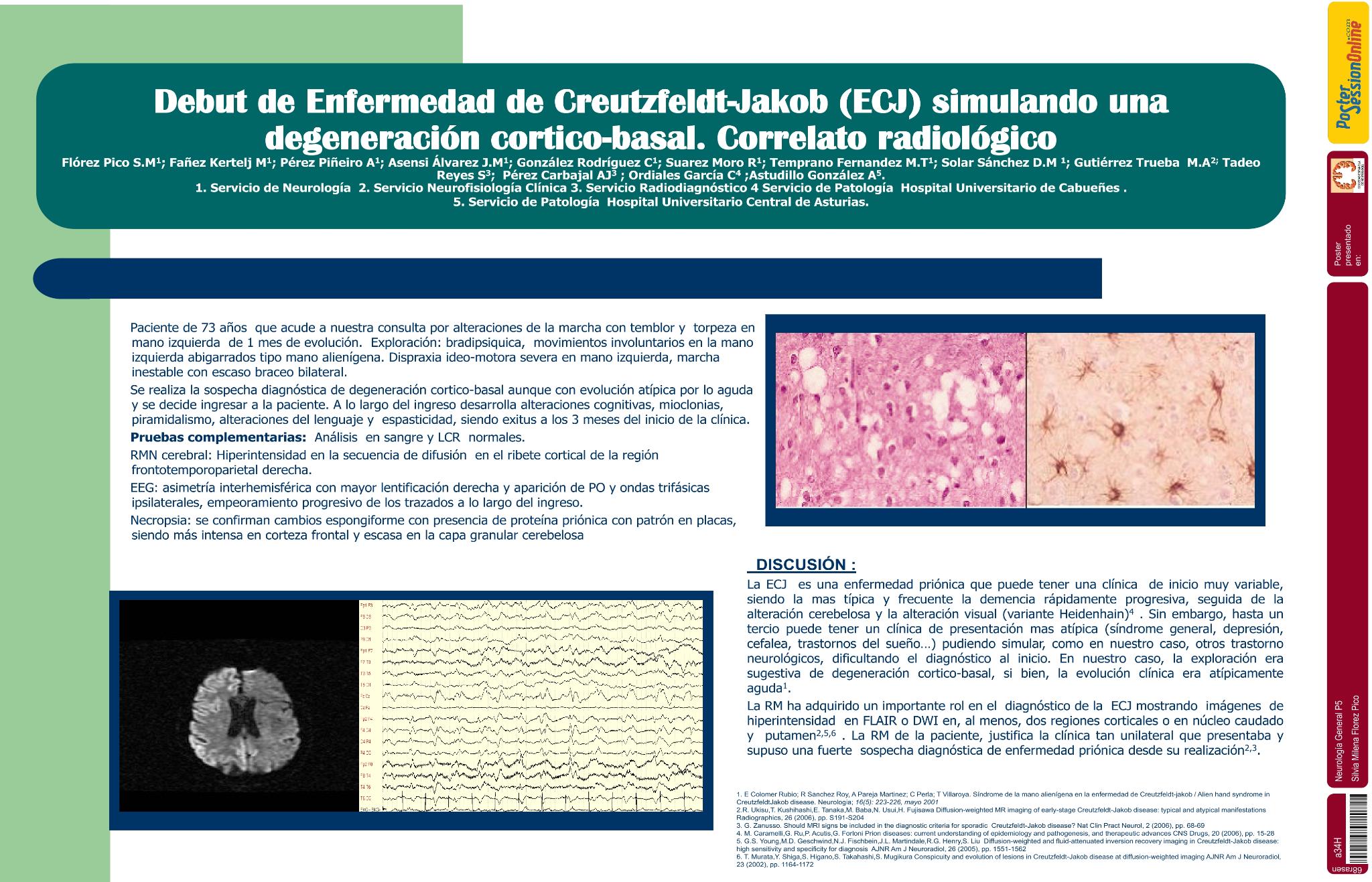 Debut de Enfermedad de Creutzfeldt-Jakob (ECJ) simulando una degeneración cortico-basal. Correlato radiológico