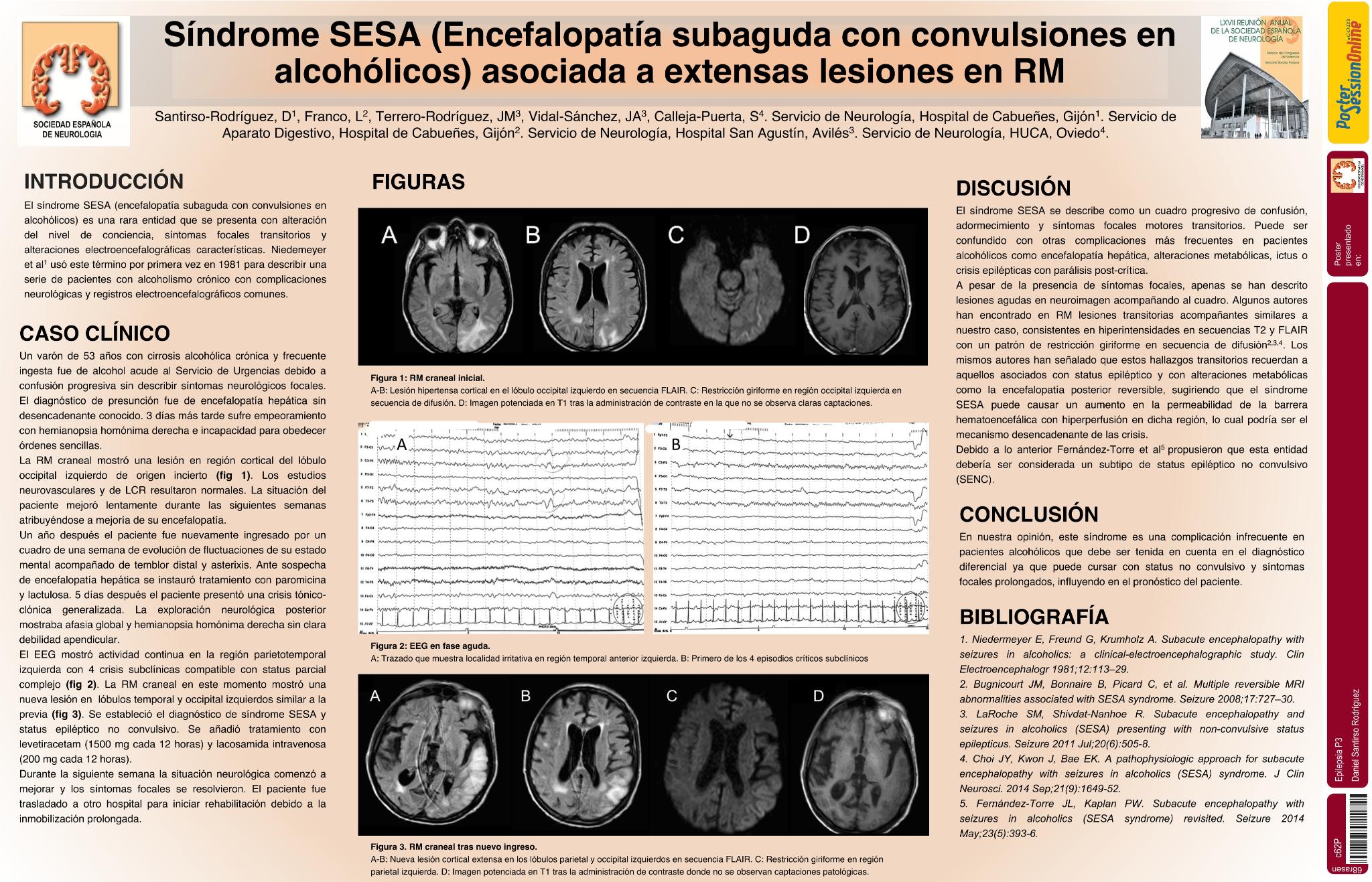 Síndrome SESA (Encefalopatía subaguda con convulsiones en alcohólicos) asociada a extensas lesiones en RM