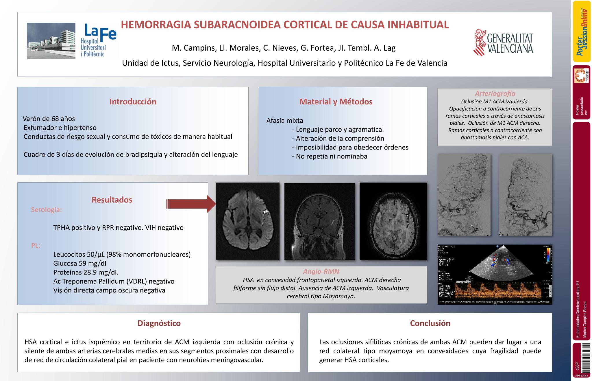 Hemorragia subaracnoidea cortical de causa inhabitual