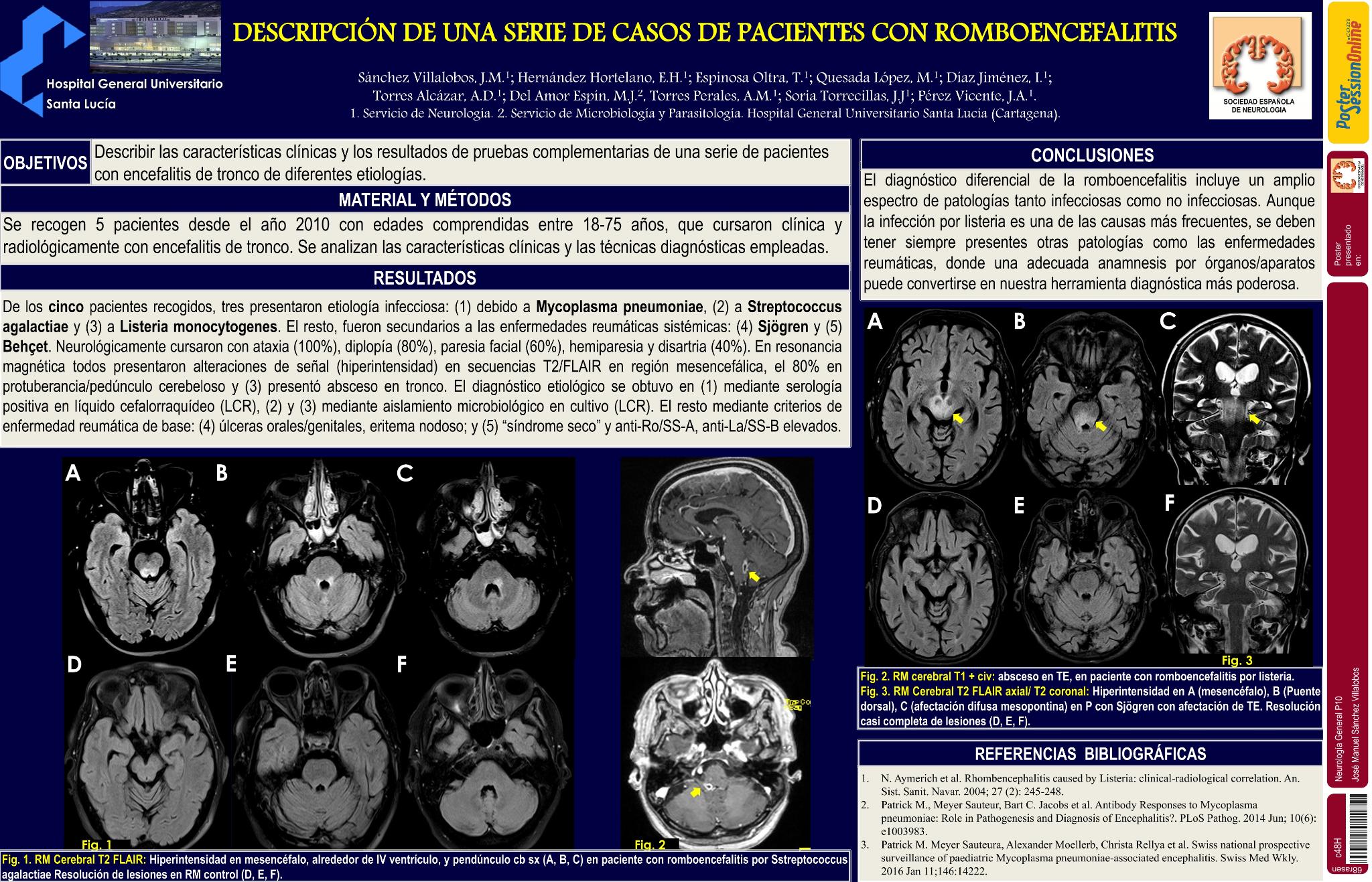 Descripción de una serie de casos de pacientes con romboencefalitis