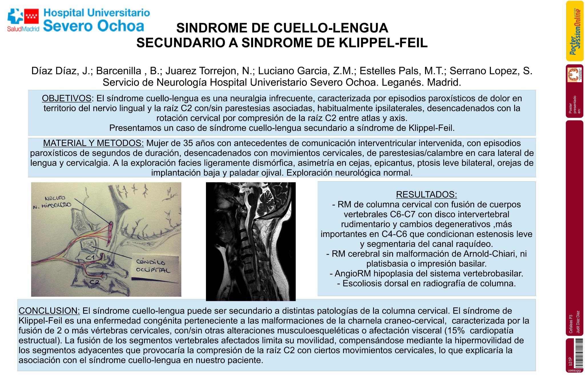 Síndrome de cuello-lengua secundario a síndrome de Klippel-Feil
