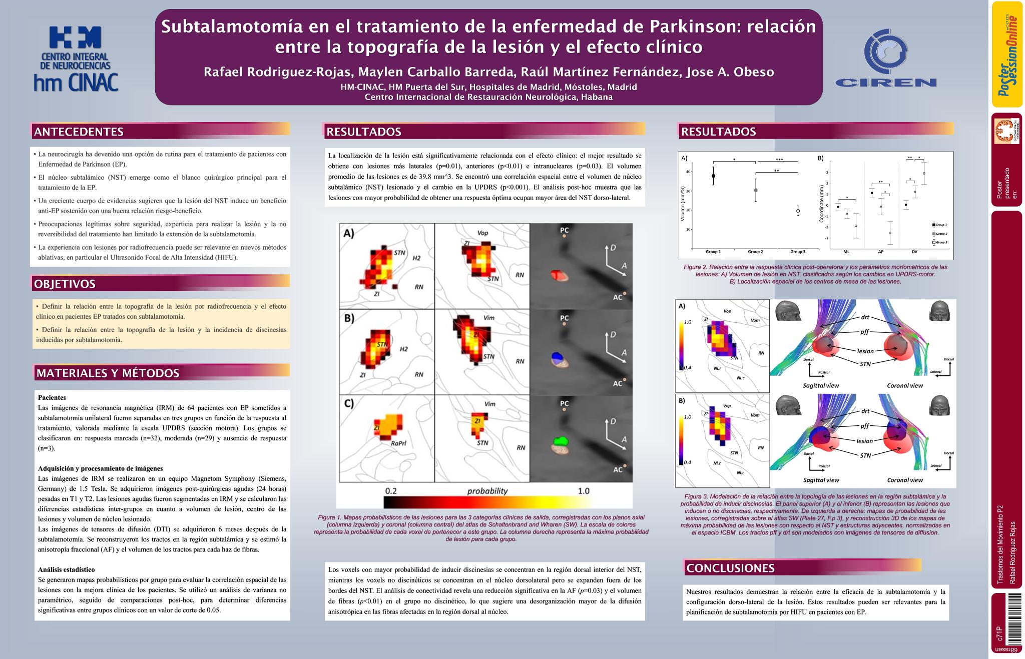 Subtalamotomía en el tratamiento de la enfermedad de Parkinson: relación entre la topografía de la lesión y el efecto clínico