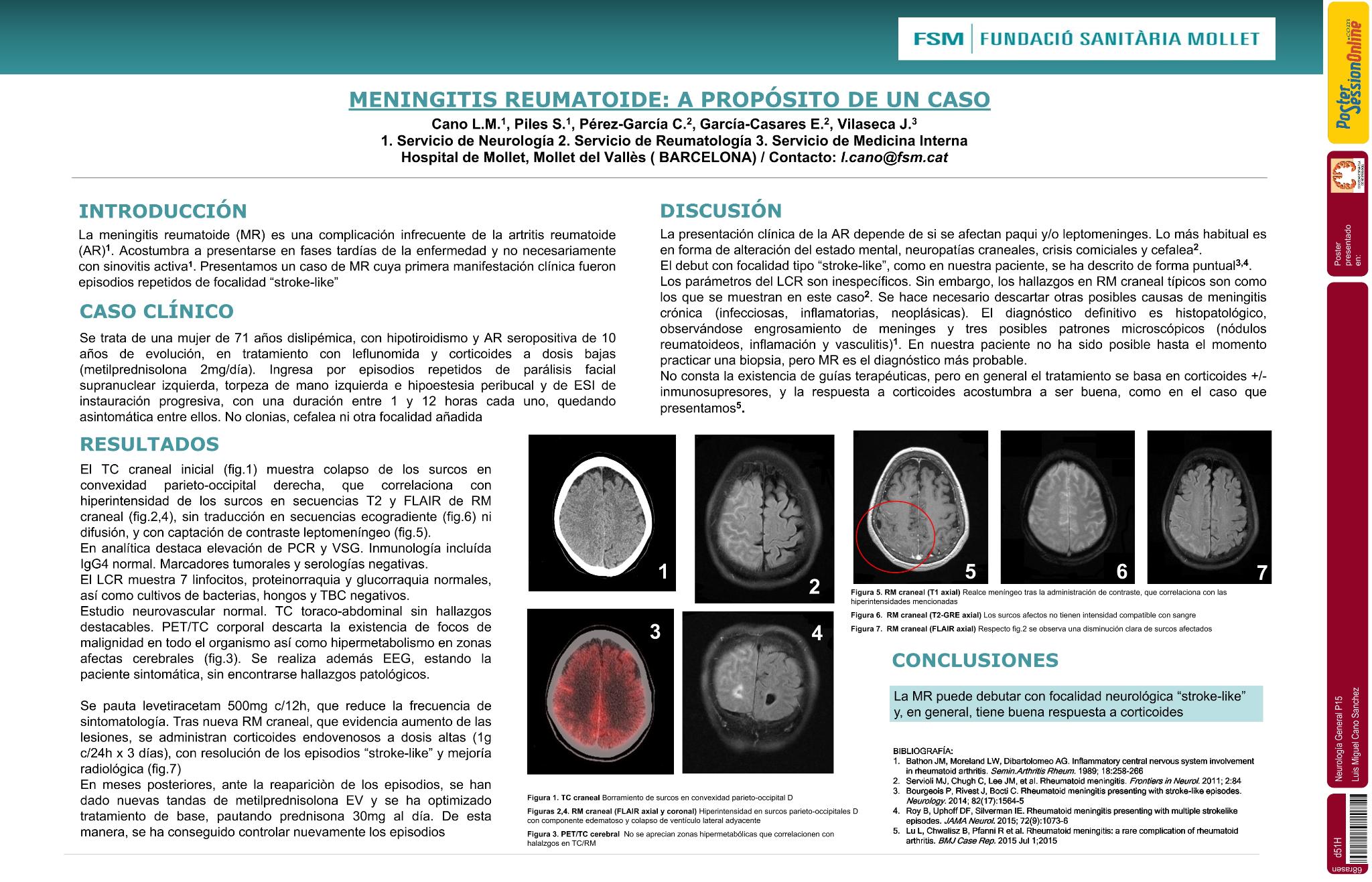 Meningitis reumatoide: a propósito de un caso