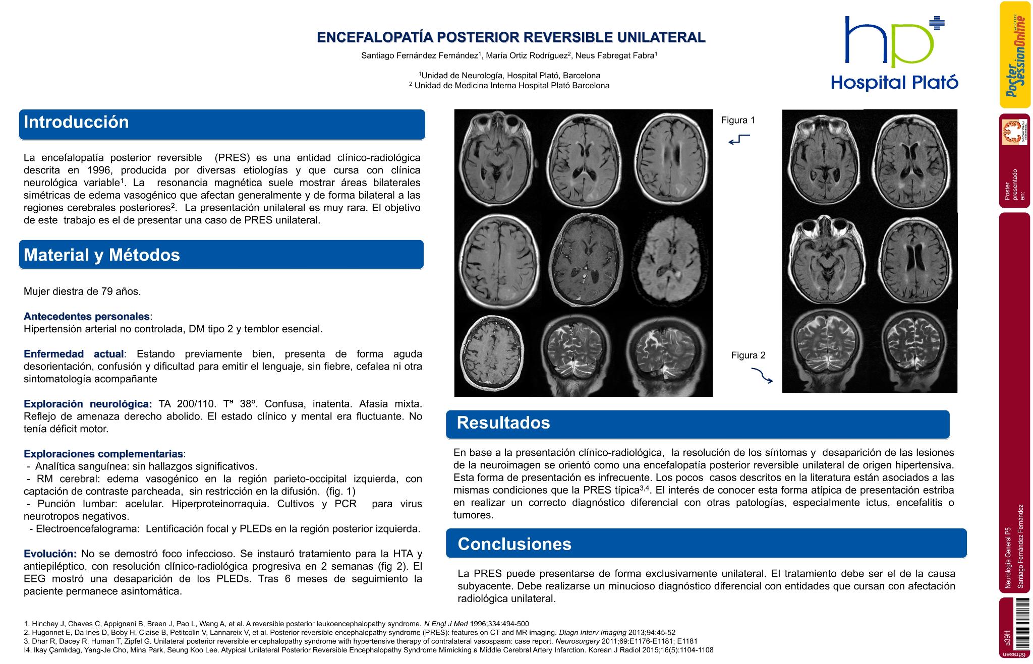 Encefalopatía posterior reversible unilateral