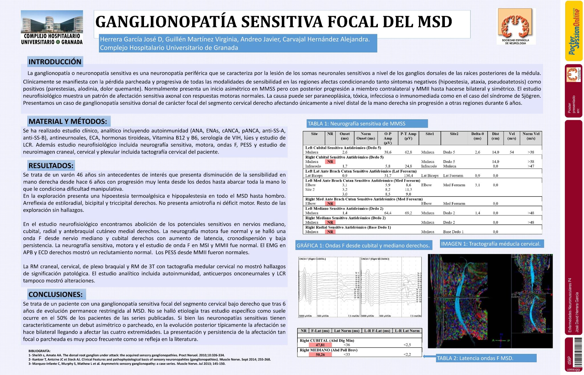 Ganglionopatía sensitiva focal del MSD