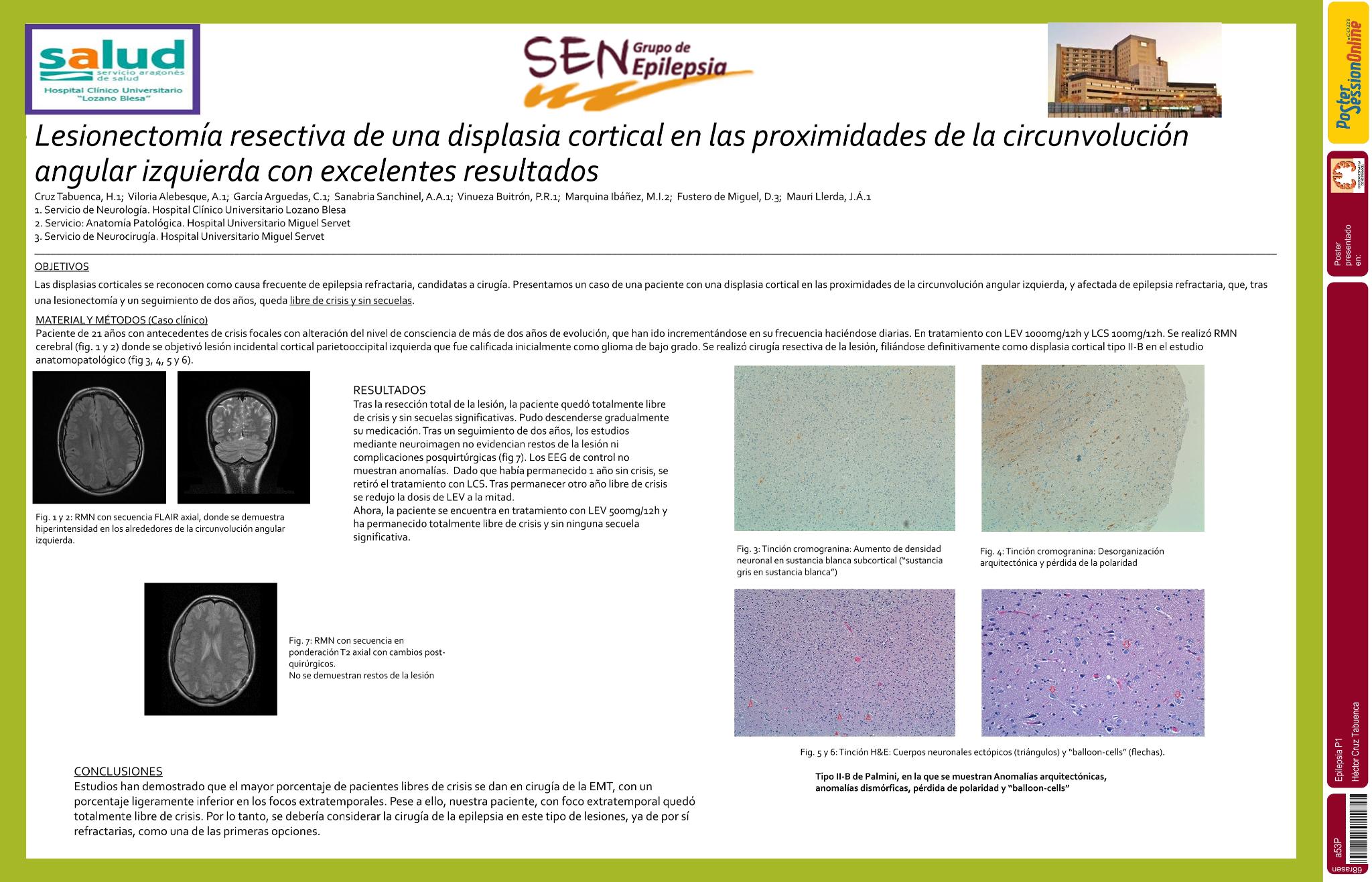 Lesionectomía resectiva de una displasia cortical en las proximidades de la circunvolución angular izquierda con excelentes resultados