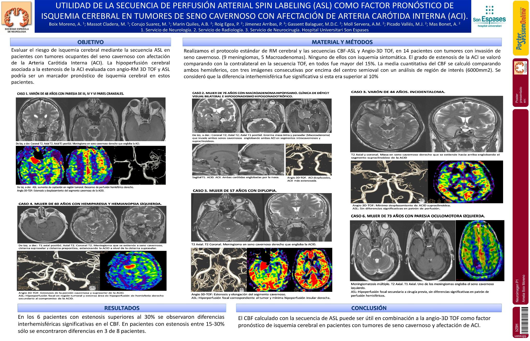Utilidad de la secuencia de perfusión Arterial Spin Labeling (ASL) como factor pronóstico de isquemia cerebral en tumores de seno cavernoso con afectación de Arteria Carótida Interna (ACI)