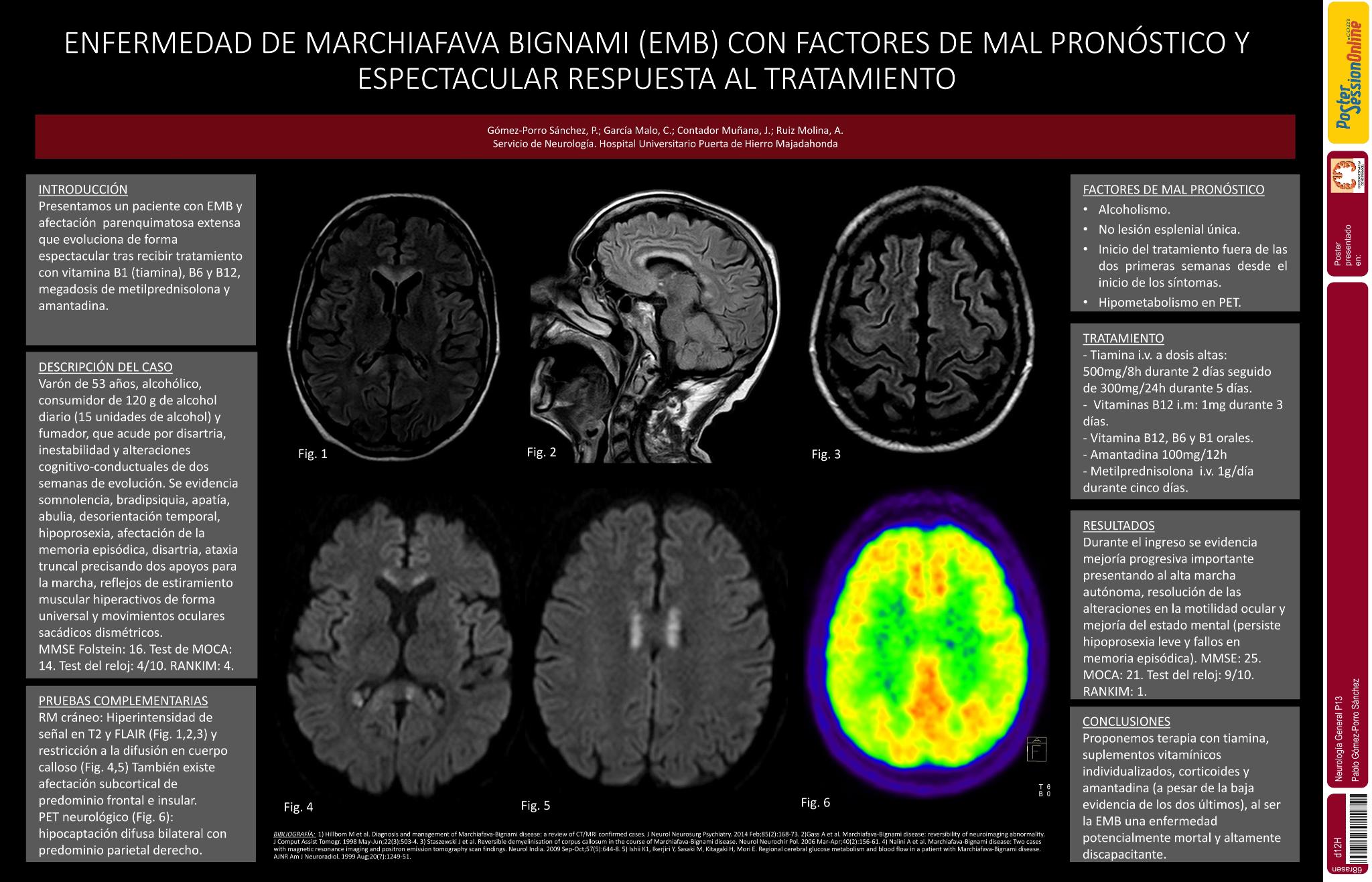 Marchiafava Bignami: respuesta espectacular tras terapia con vitaminas (B1,B12,B6), corticoides y amantadina