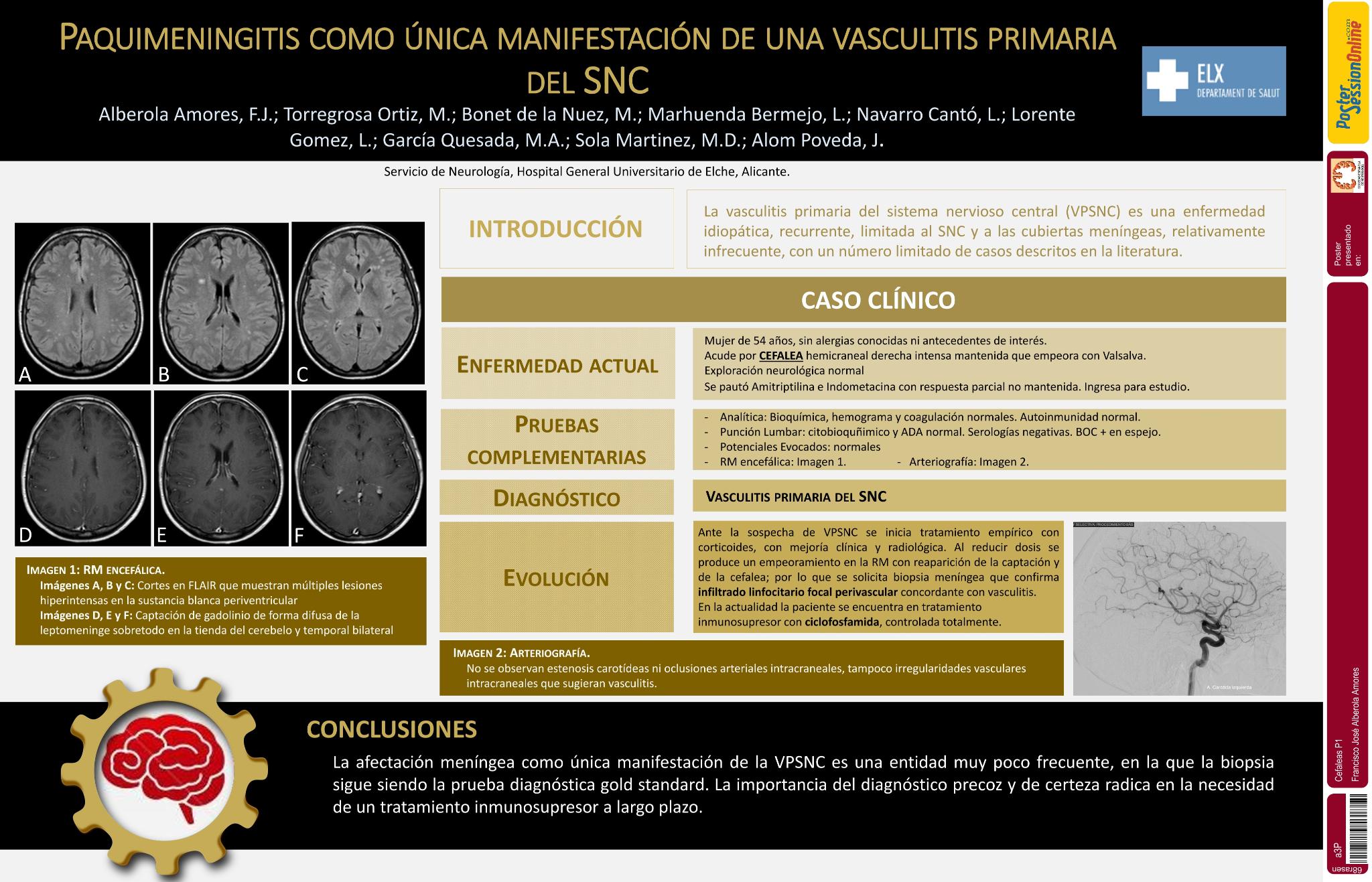 Paquimeningitis como única manifestación de una vasculitis primaria del SNC