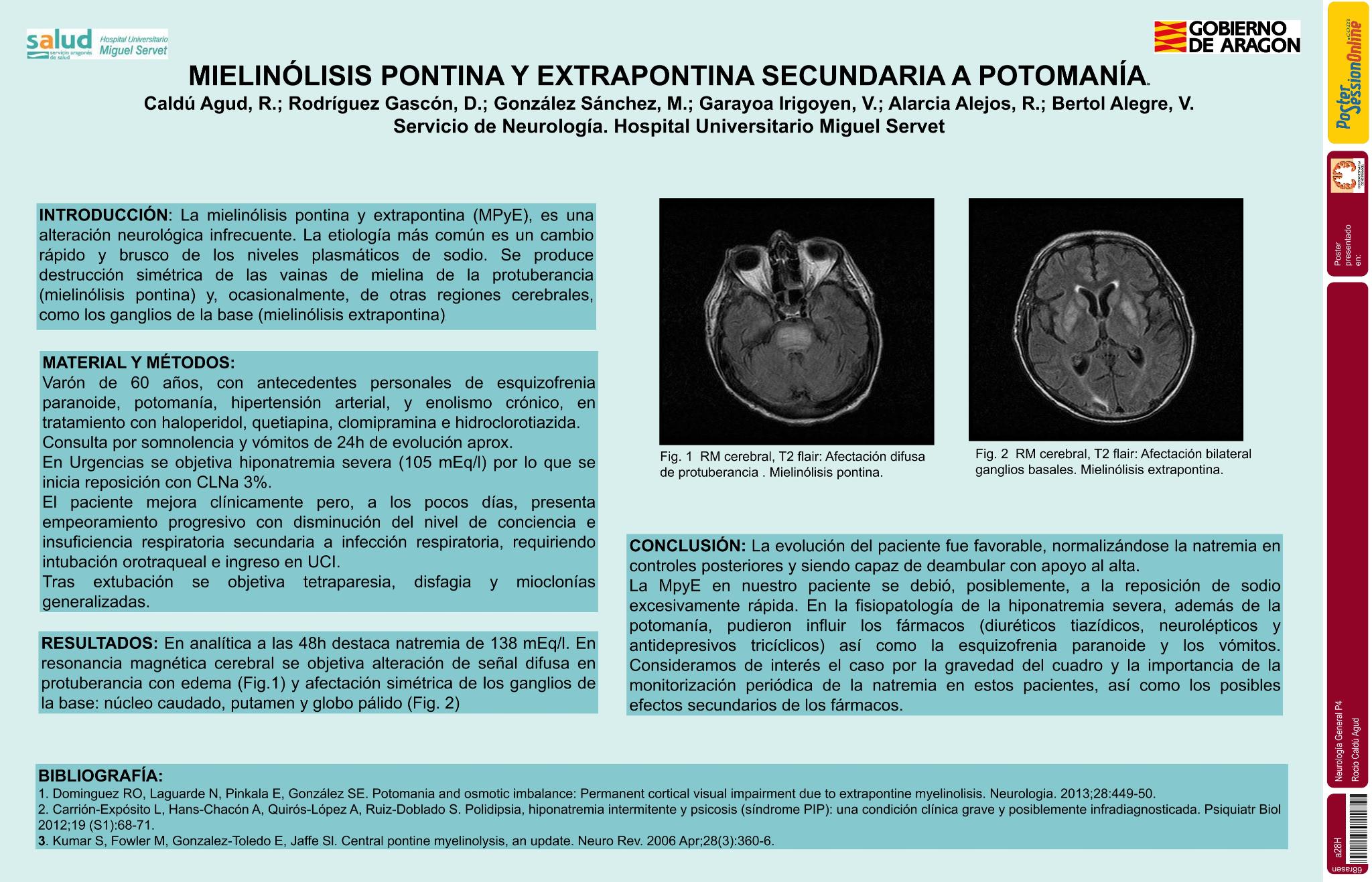 Mielinólisis pontina y extrapontina secundaria a potomanía