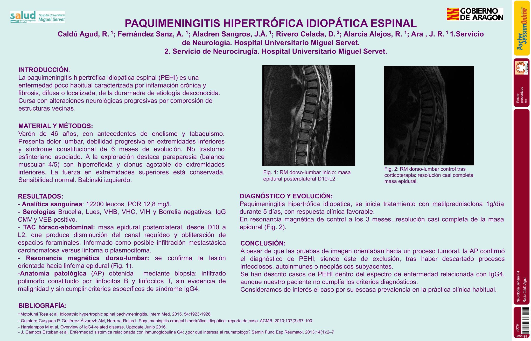Paquimeningitis hipertrófica idiopática espinal