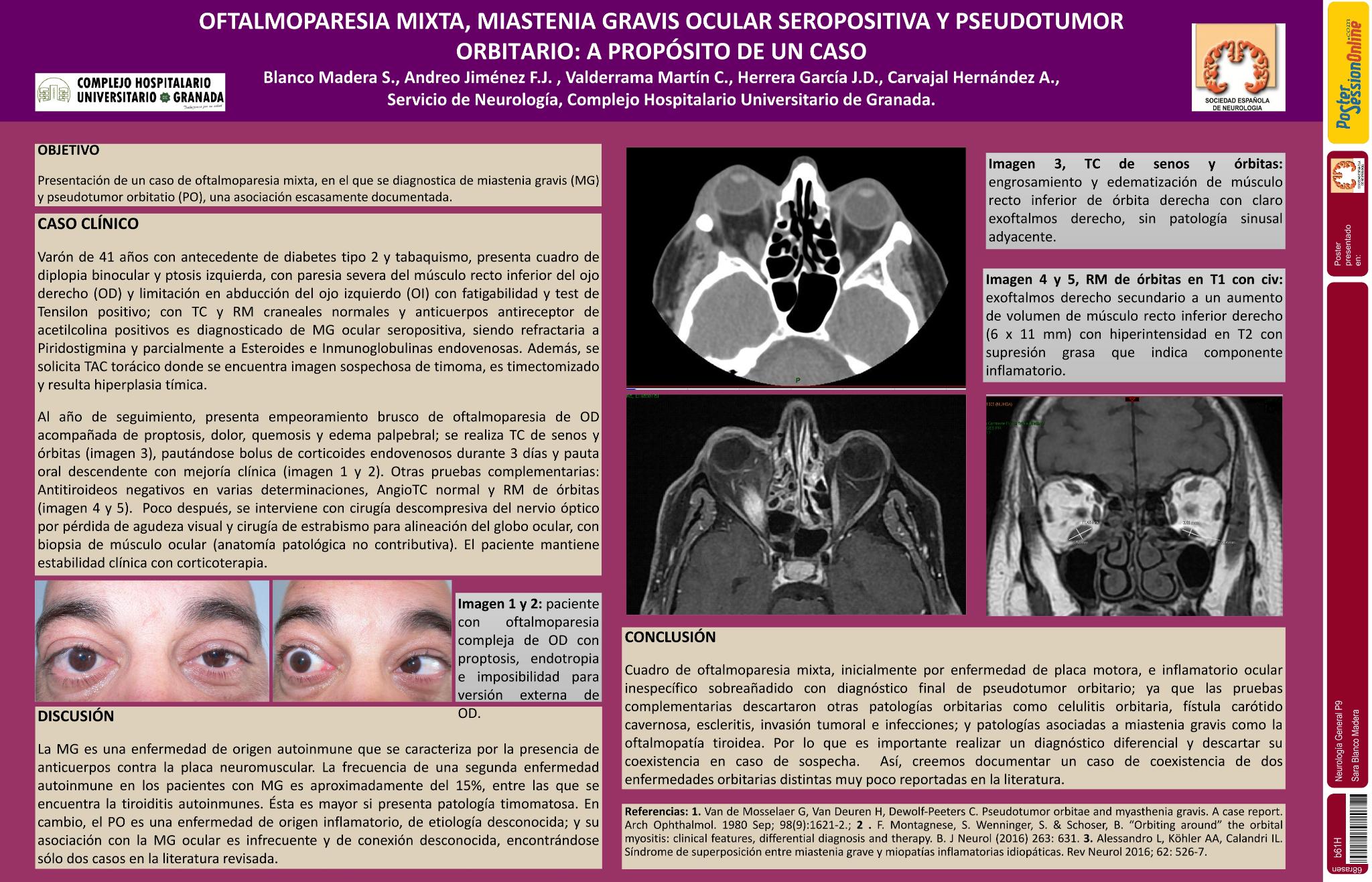 Oftalmoparesia mixta, miastenia gravis ocular seropositiva y pseudotumor orbitario: a propósito de un caso