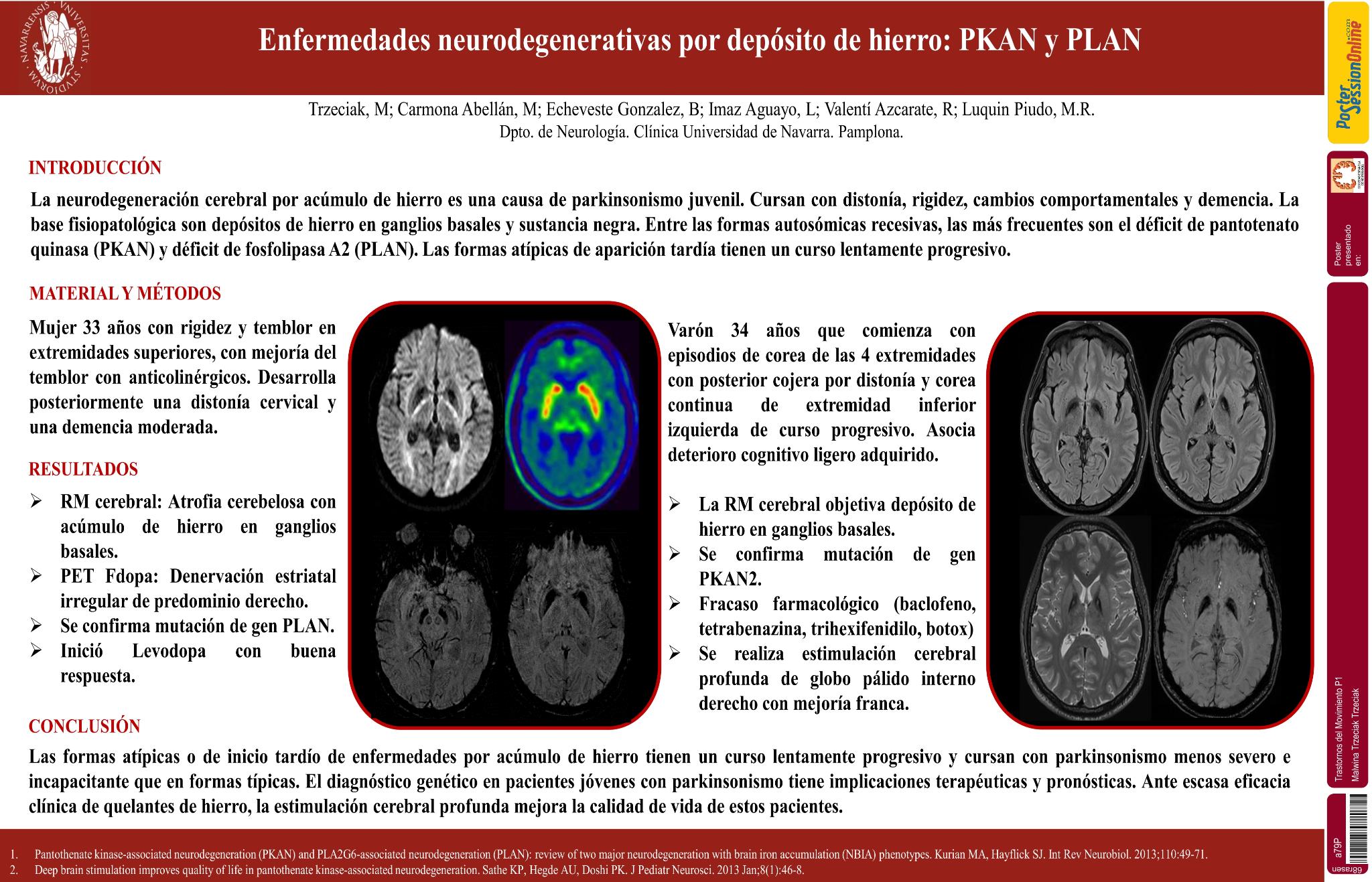 Enfermedades neurodegenerativas por depósito de hierro: PKAN y PLAN