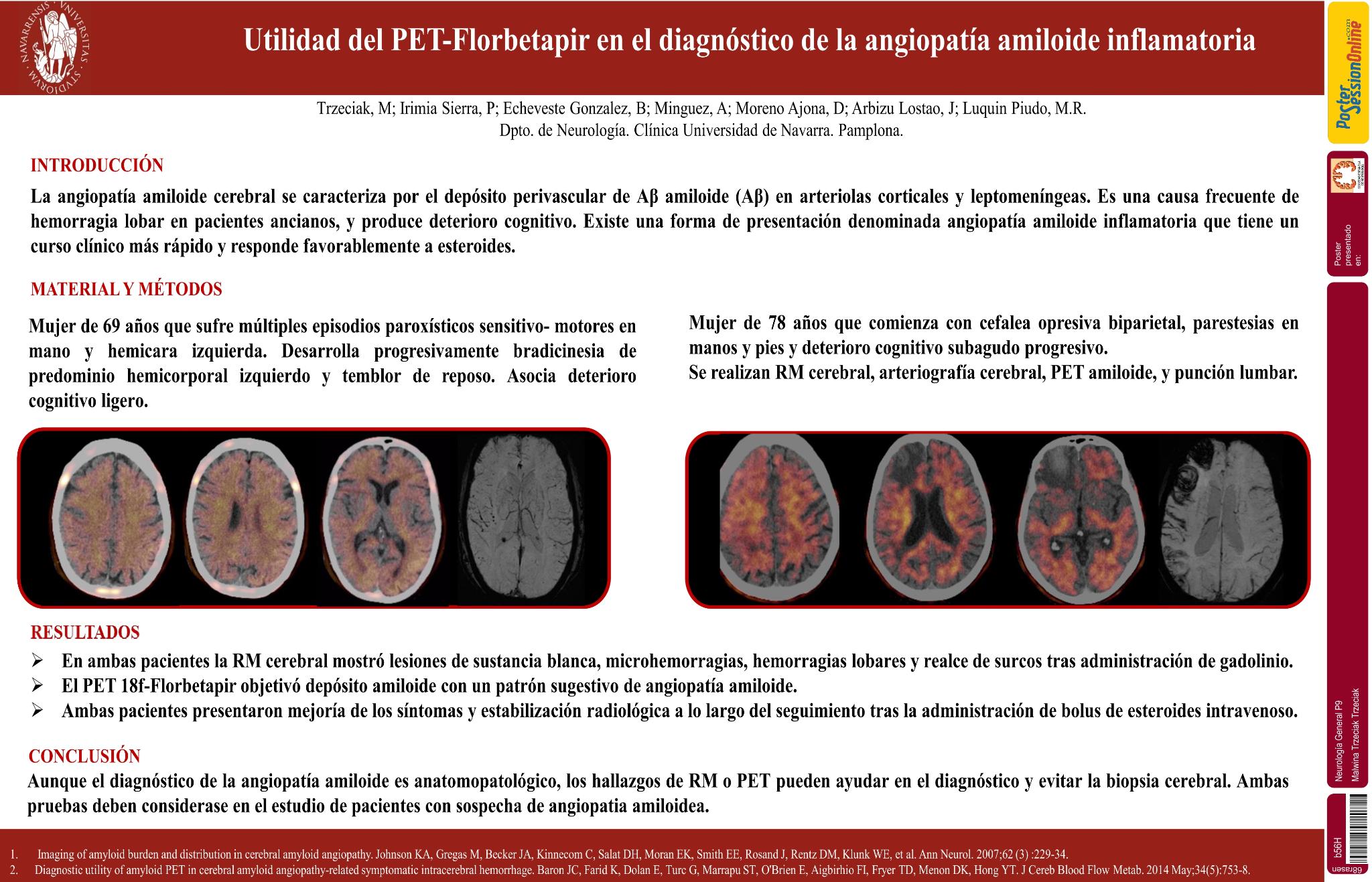 Utilidad del PET-Florbetapir en el diagnóstico de la angiopatía amiloide inflamatoria: a propósito de 2 casos