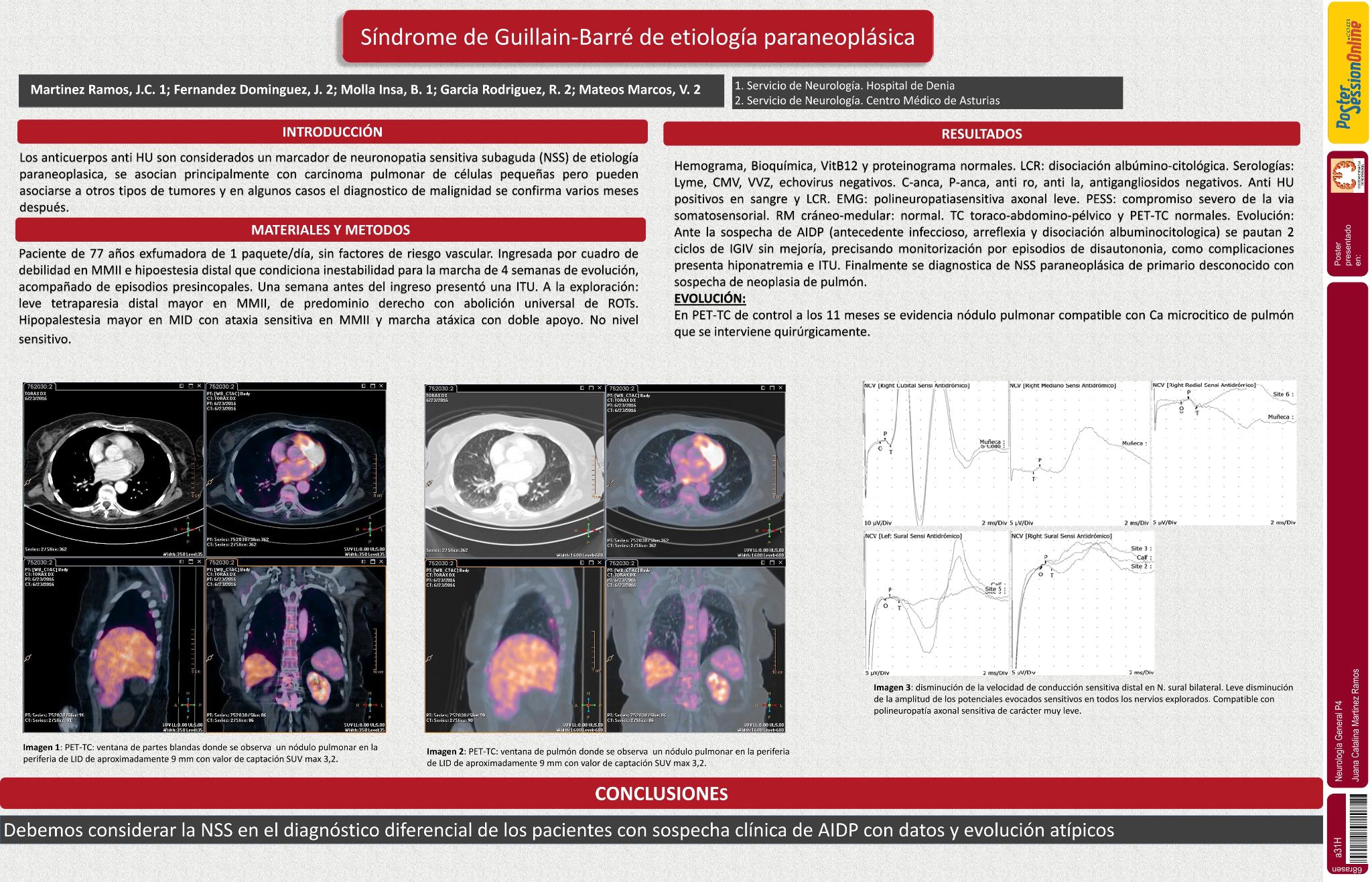 Síndrome de Guillain-Barré de etiología paraneoplásica