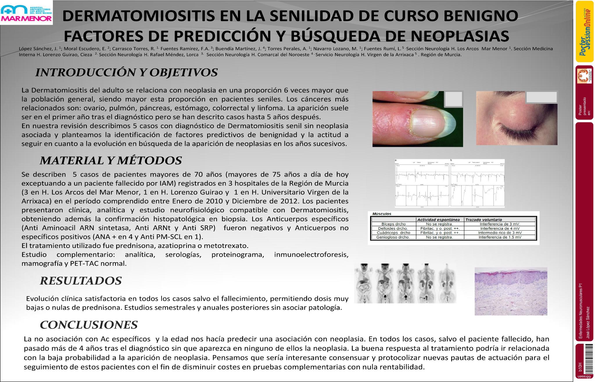 Dermatomiositis en la senilidad de curso benigno. Factores de predicción y  limitación temporal en la búsqueda de neoplasia