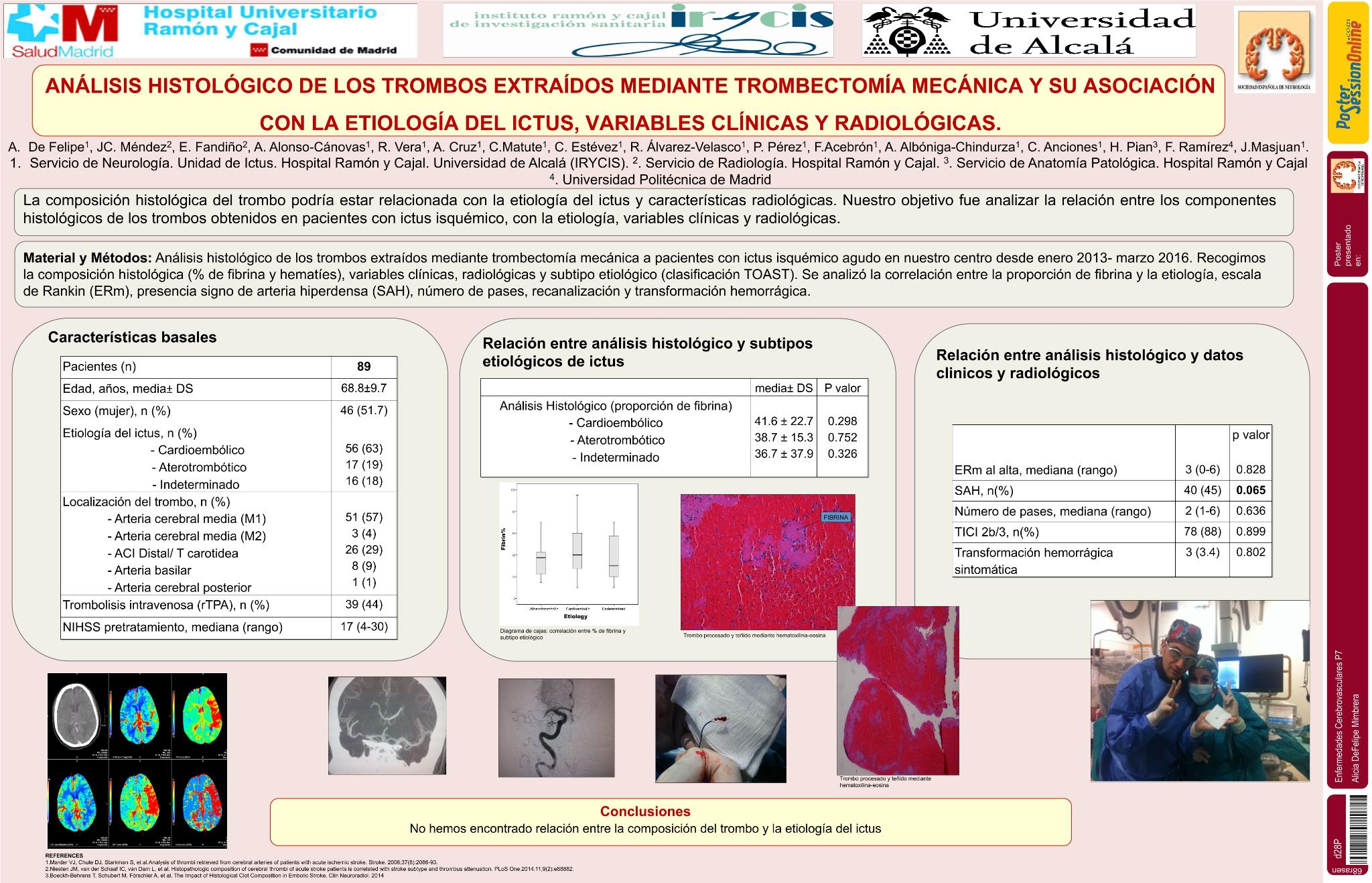 Análisis histológico de los trombos extraídos mediante trombectomía mecánica y su asociación con la etiología del ictus, variables clínicas y radiológicas