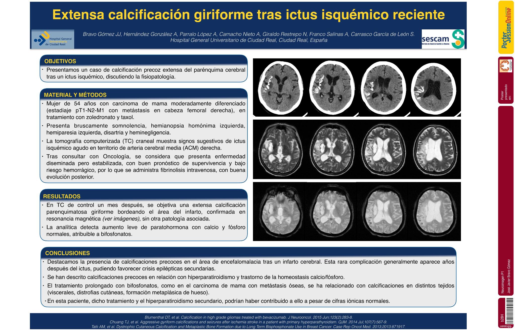 Extensa calcificación giriforme tras ictus isquémico reciente