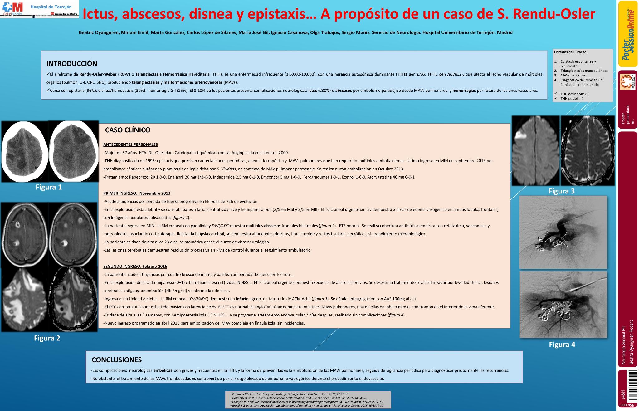 Ictus, abscesos, disnea y epistaxis... a propósito de un caso de S. Rendu-Osler