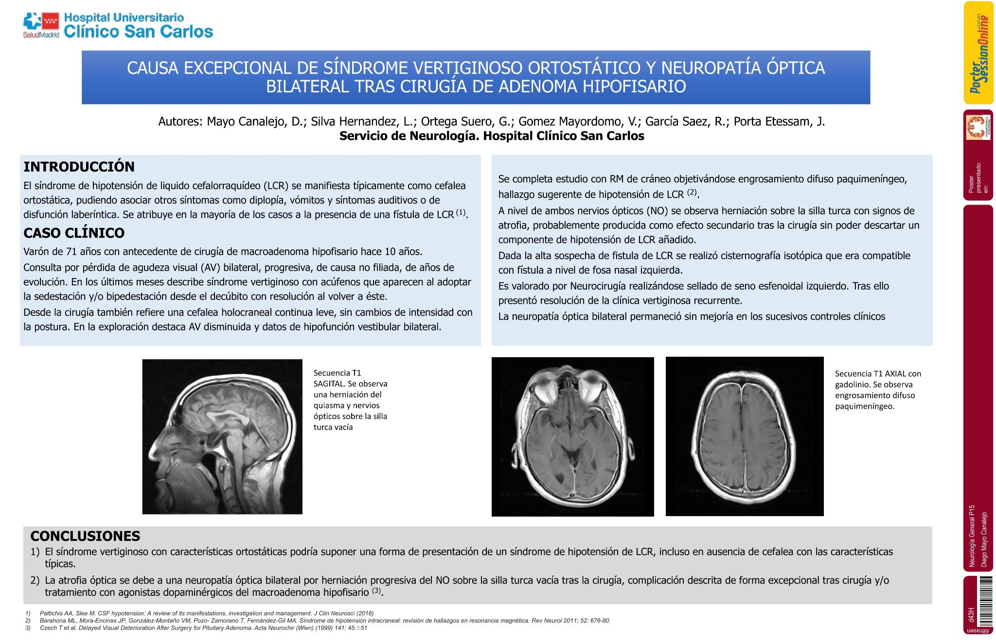 Causa excepcional de síndrome vertiginoso ortostático y neuropatía óptica bilateral tras cirugía de adenoma hipofisario