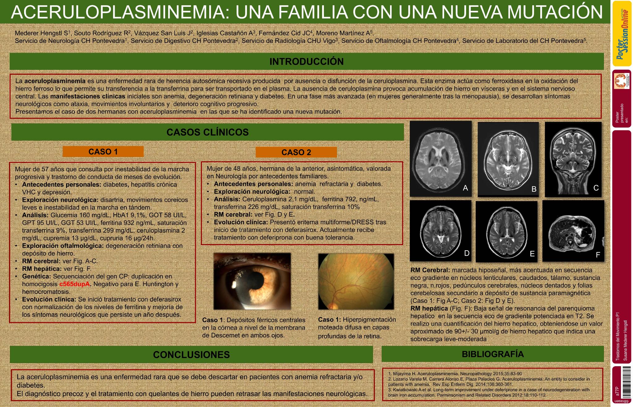Aceruloplasminemia: una familia con una nueva mutación