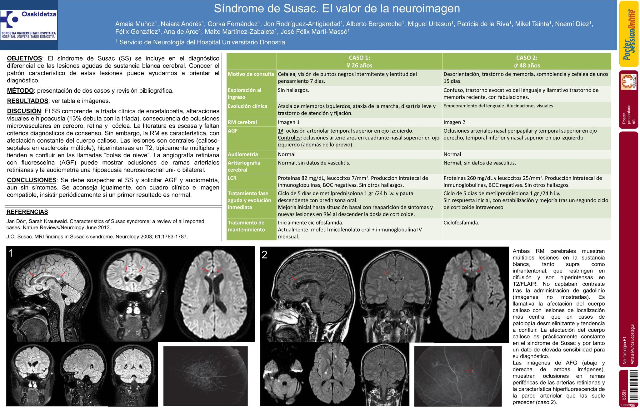 Síndrome de Susac. El valor de la neuroimagen