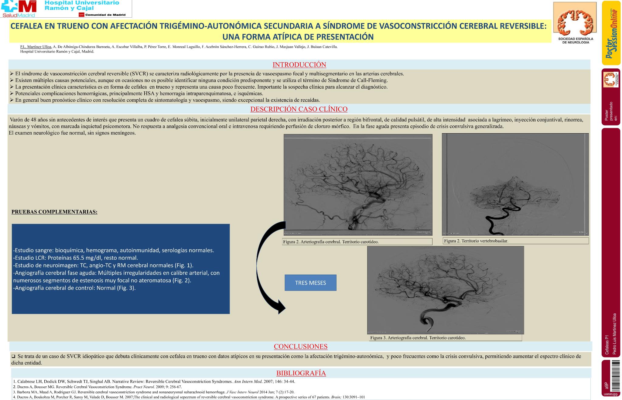 Cefalea en trueno con afectación trigémino-autonómica secundaria a síndrome de vasoconstricción cerebral reversible: una forma atípica de presentación