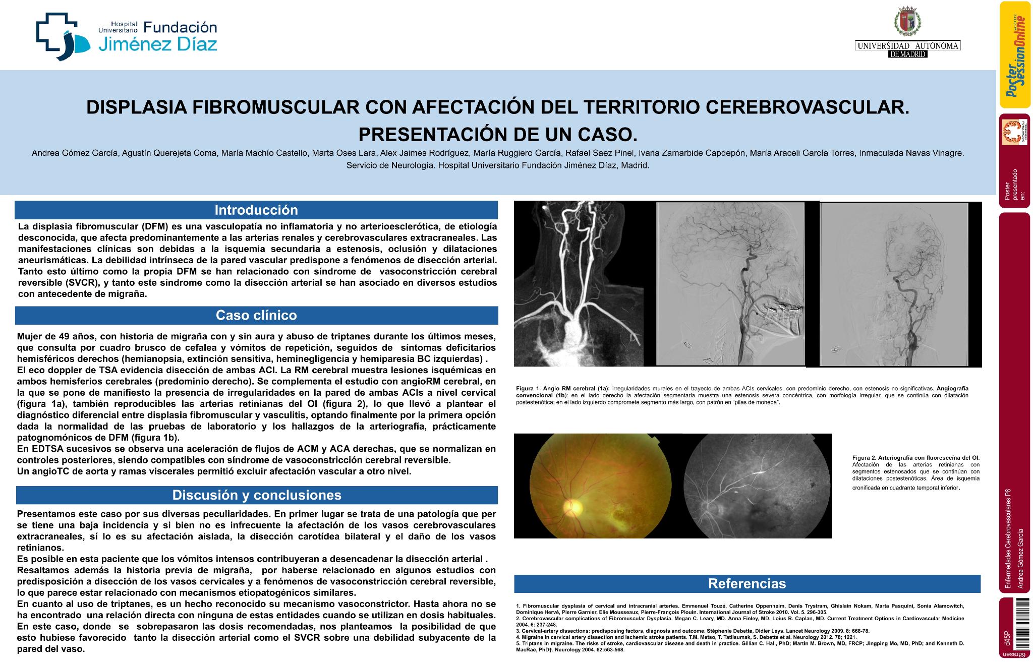 Descripción de un caso de displasia fibromuscular con afectación del territorio cerebrovascular