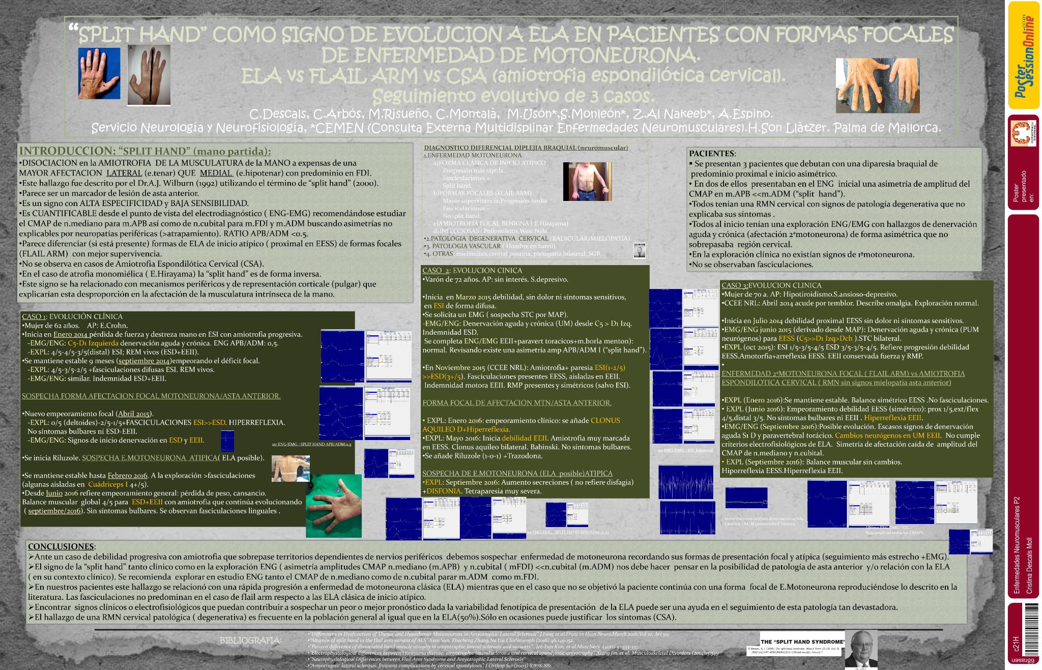 “Split hand” como signo de evolucion a ela en pacientes con formas focales de enfermedad de motoneurona.  ELA vs FLAIL ARM vs CSA. Seguimiento evolutivo de 3 casos
