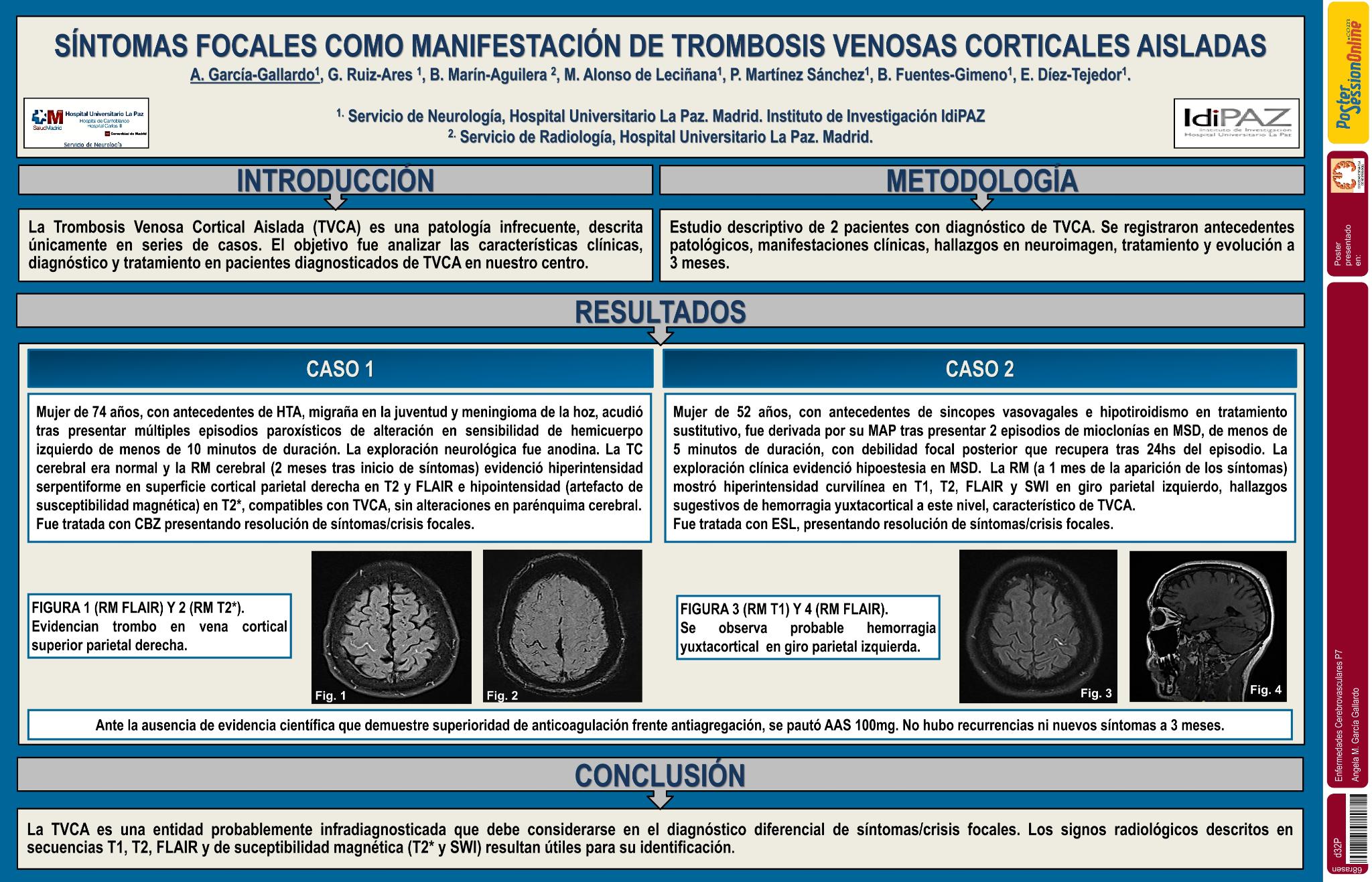 Síntomas focales como manifestación de trombosis venosa cortical aislada