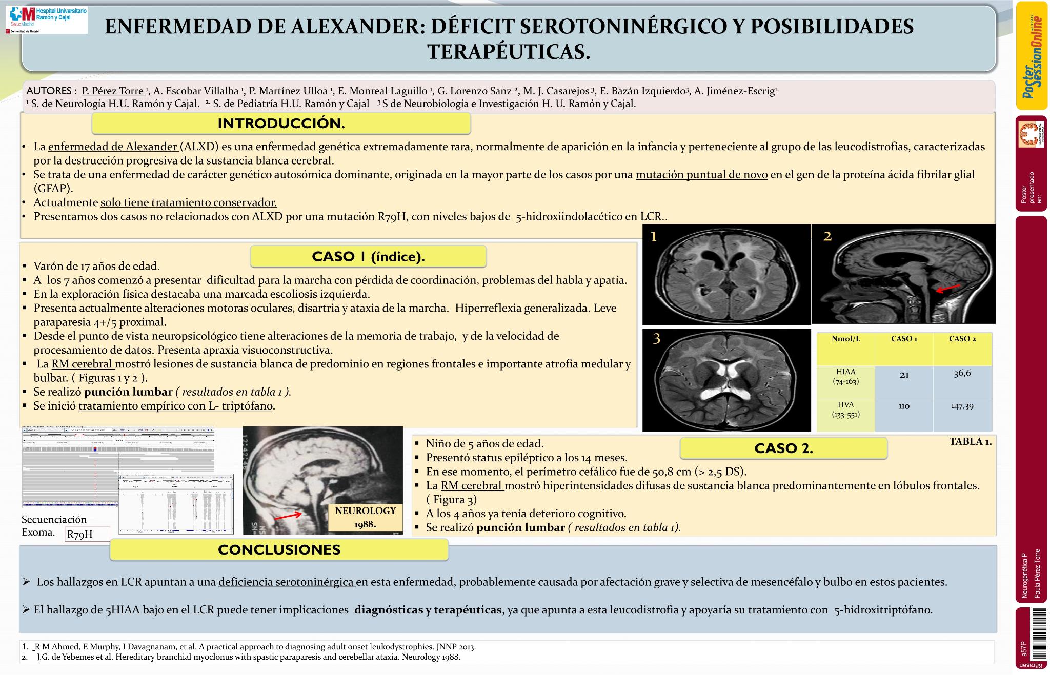 Enfermedad de Alexander: deficit serotoninergico y posibilidades terapeuticas