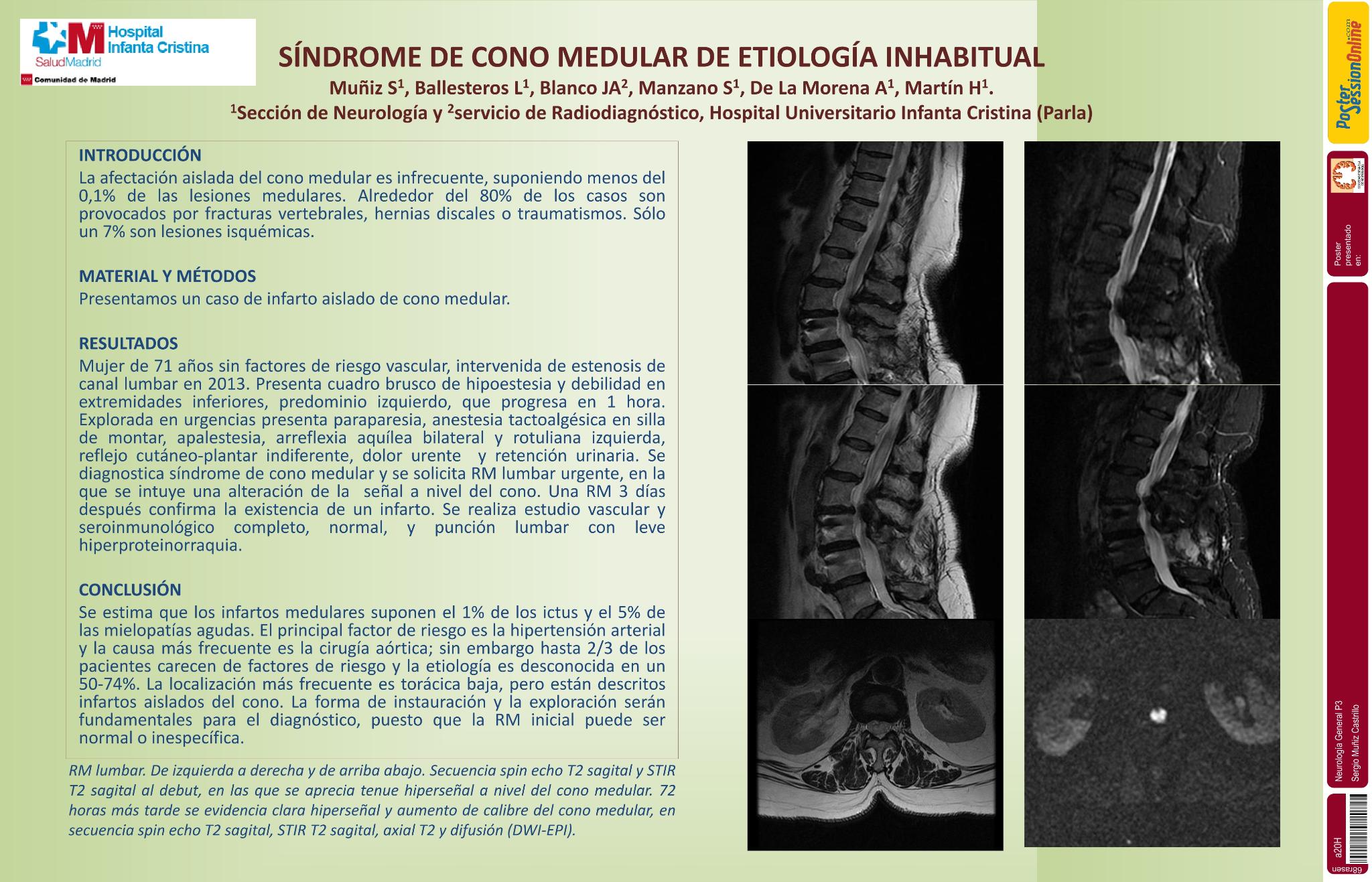 Síndrome de cono medular de etiología inhabitual