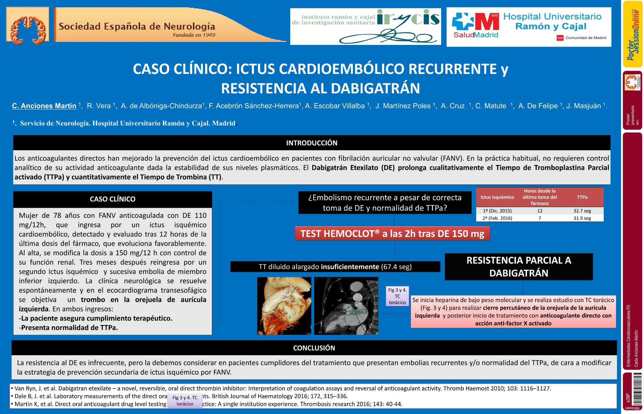 Caso clínico: ictus cardioembólico recurrente y resistencia al dabigatrán