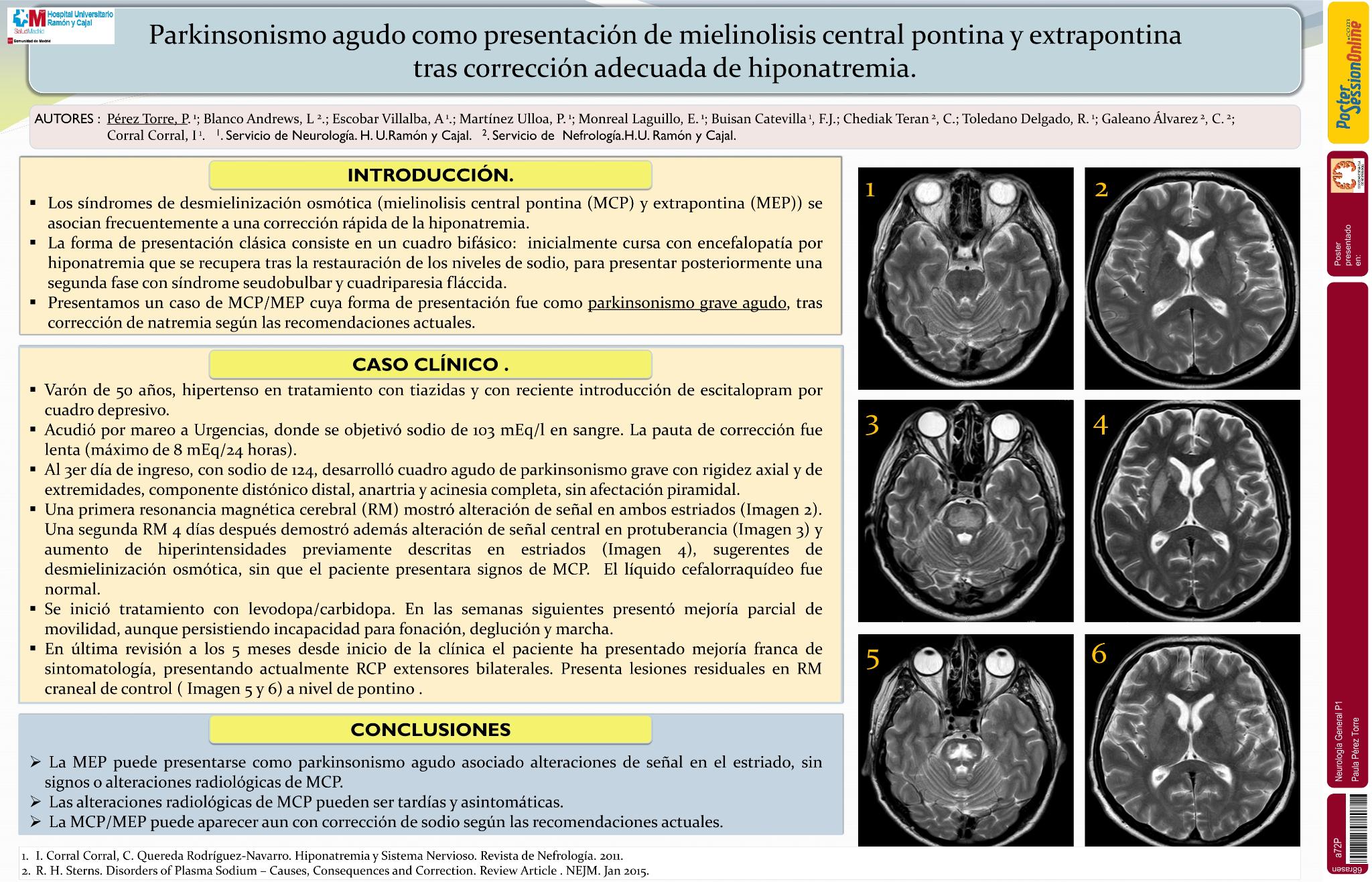 Parkinsonismo agudo como única presentación de mielinolisis central pontina y extrapontina tras corrección adecuada de hiponatremia