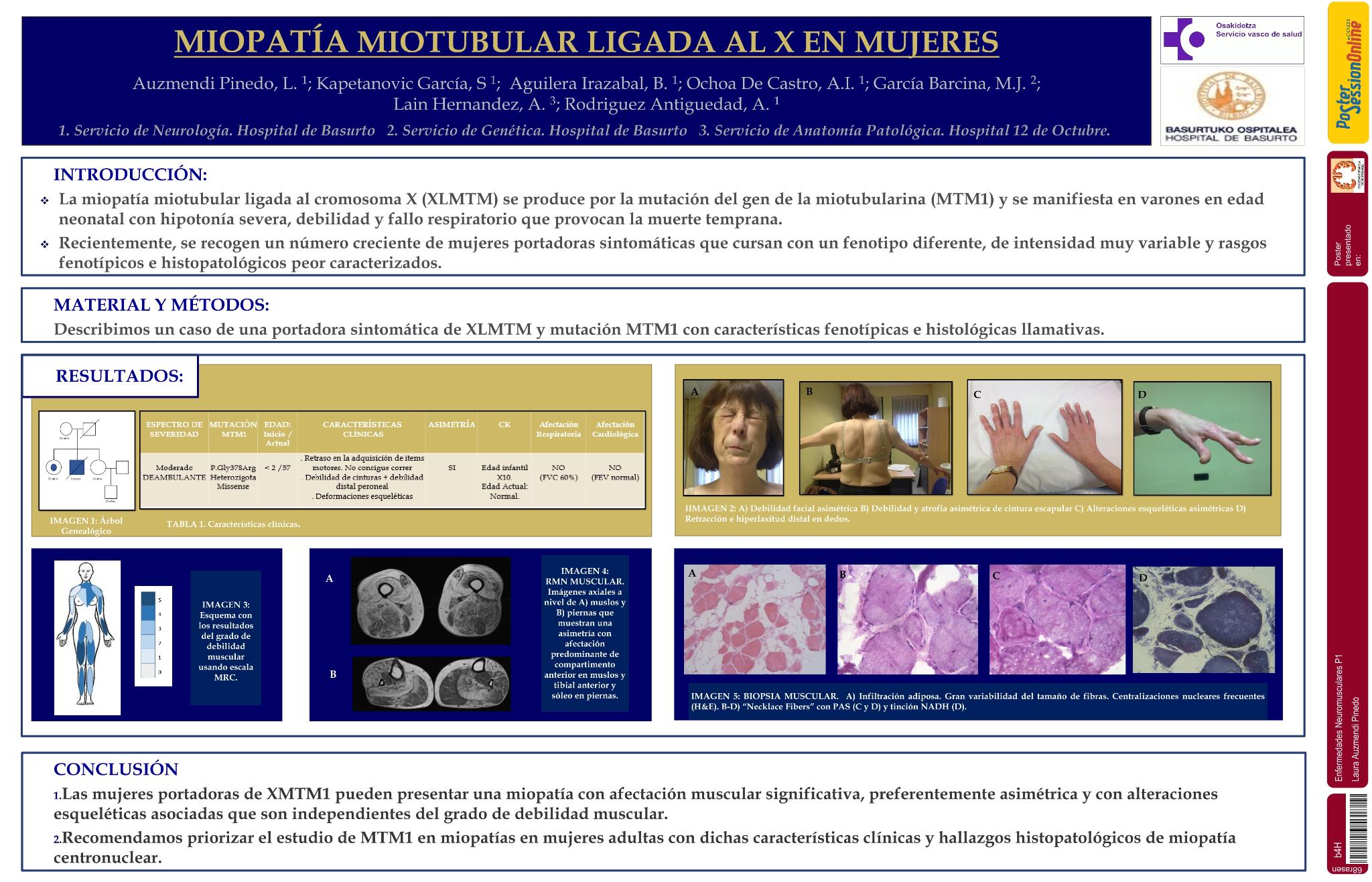 Miopatía miotubular ligada al x en mujeres