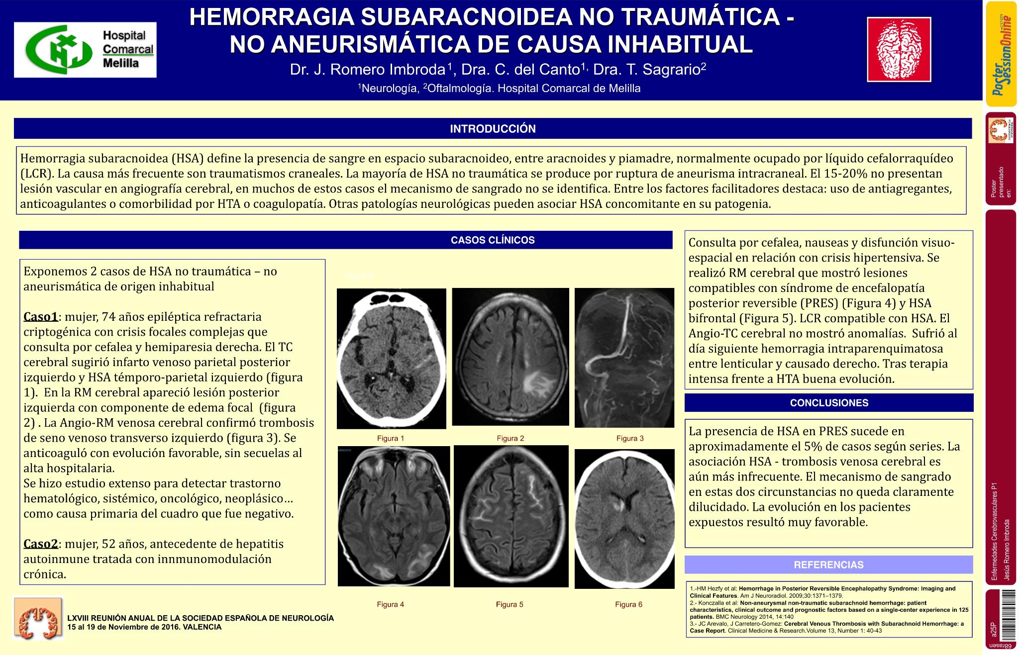 Hemorragia subaracnoidea no traumática - no aneurismática de causa inhabitual