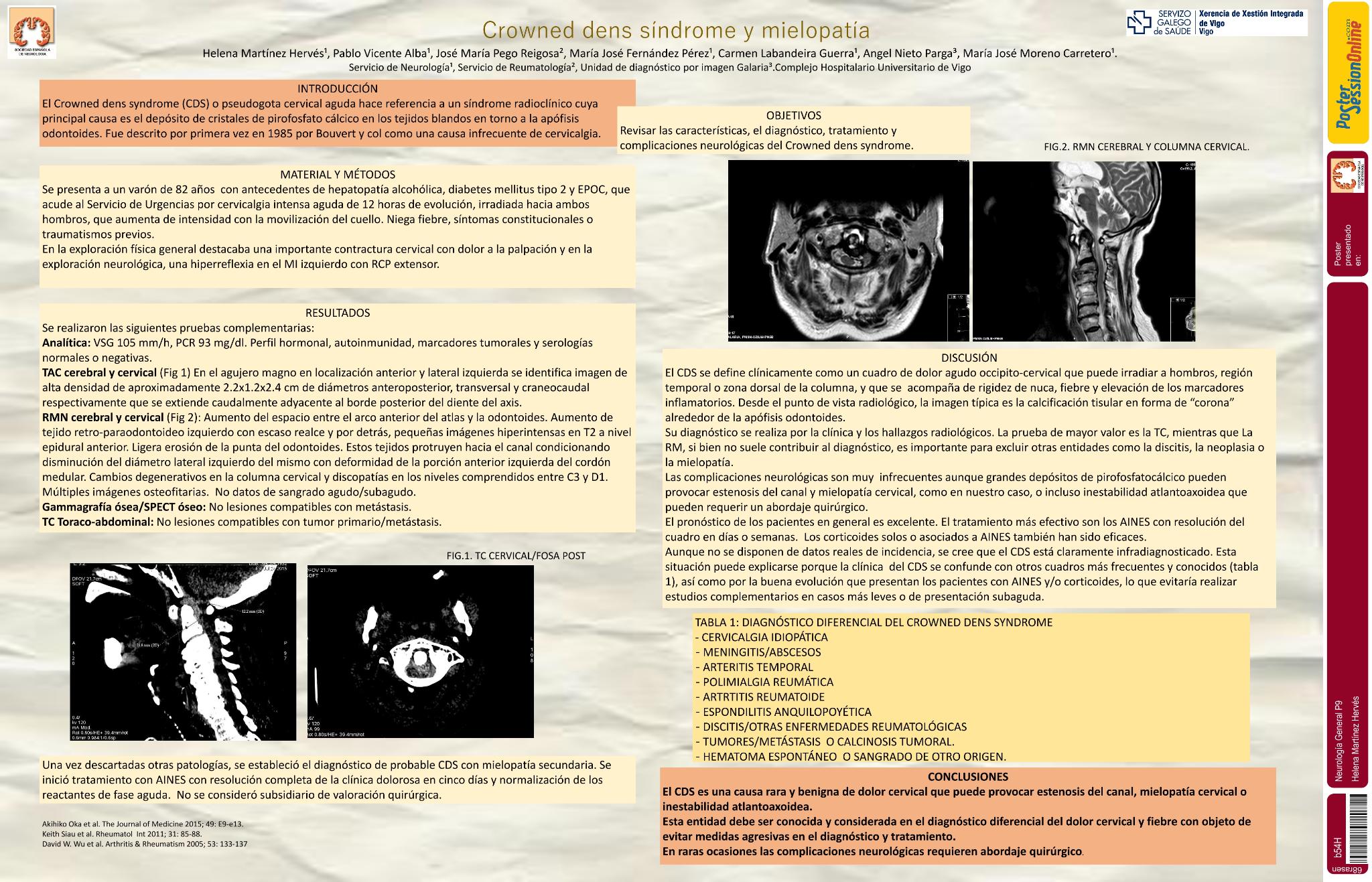Crowned dens syndrome y mielopatía