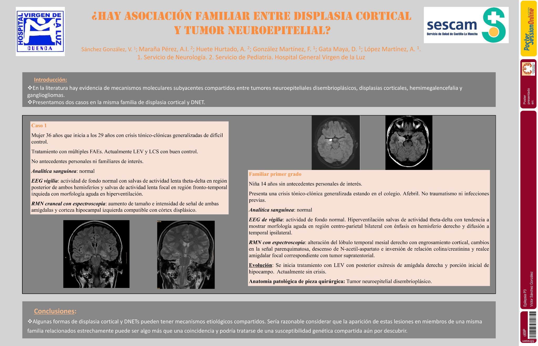 ¿Hay asociación familiar entre displasia cortical y tumor neuroepitelial?