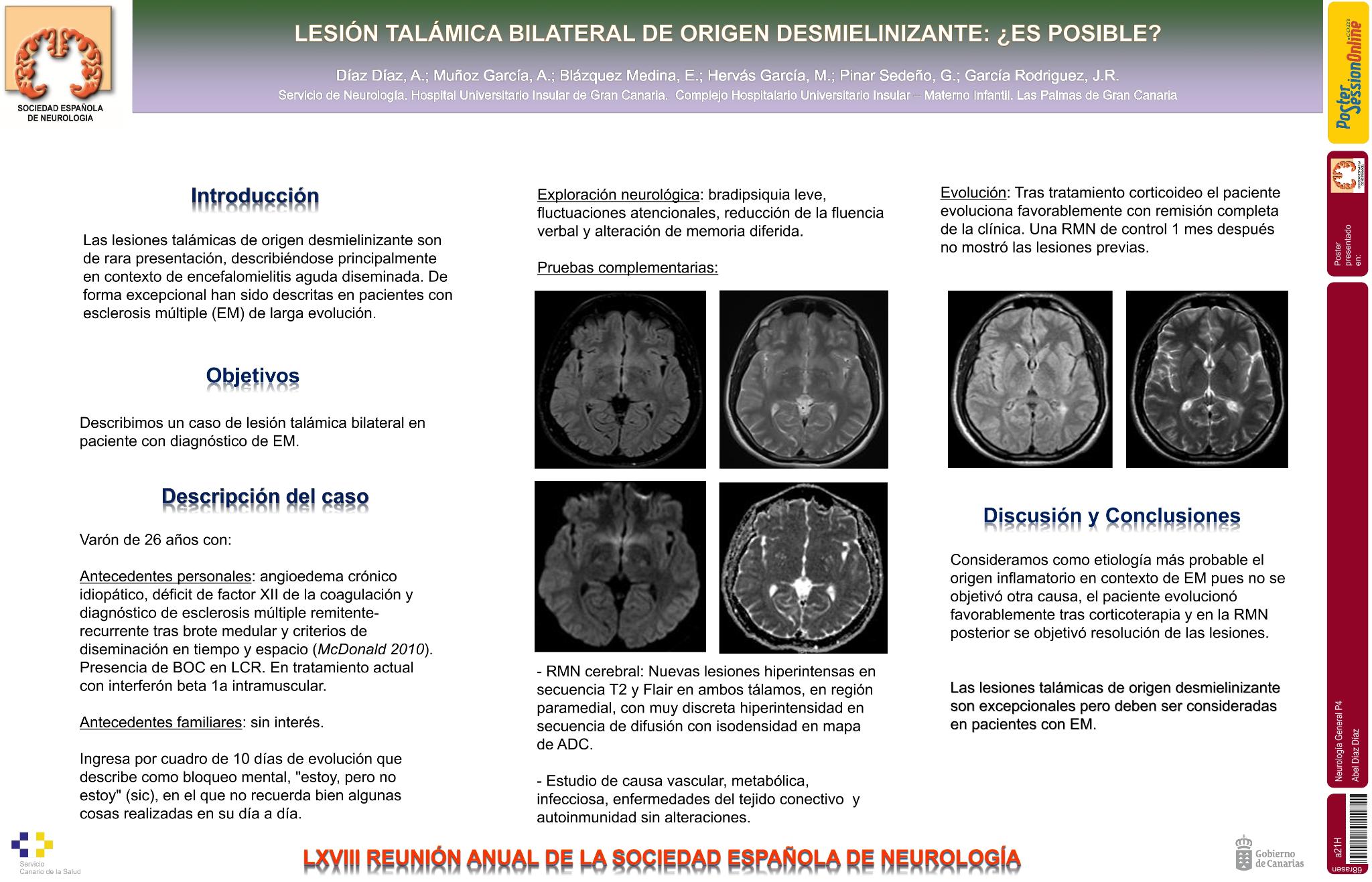 Lesión talámica bilateral de origen desmielinizante: ¿es posible?