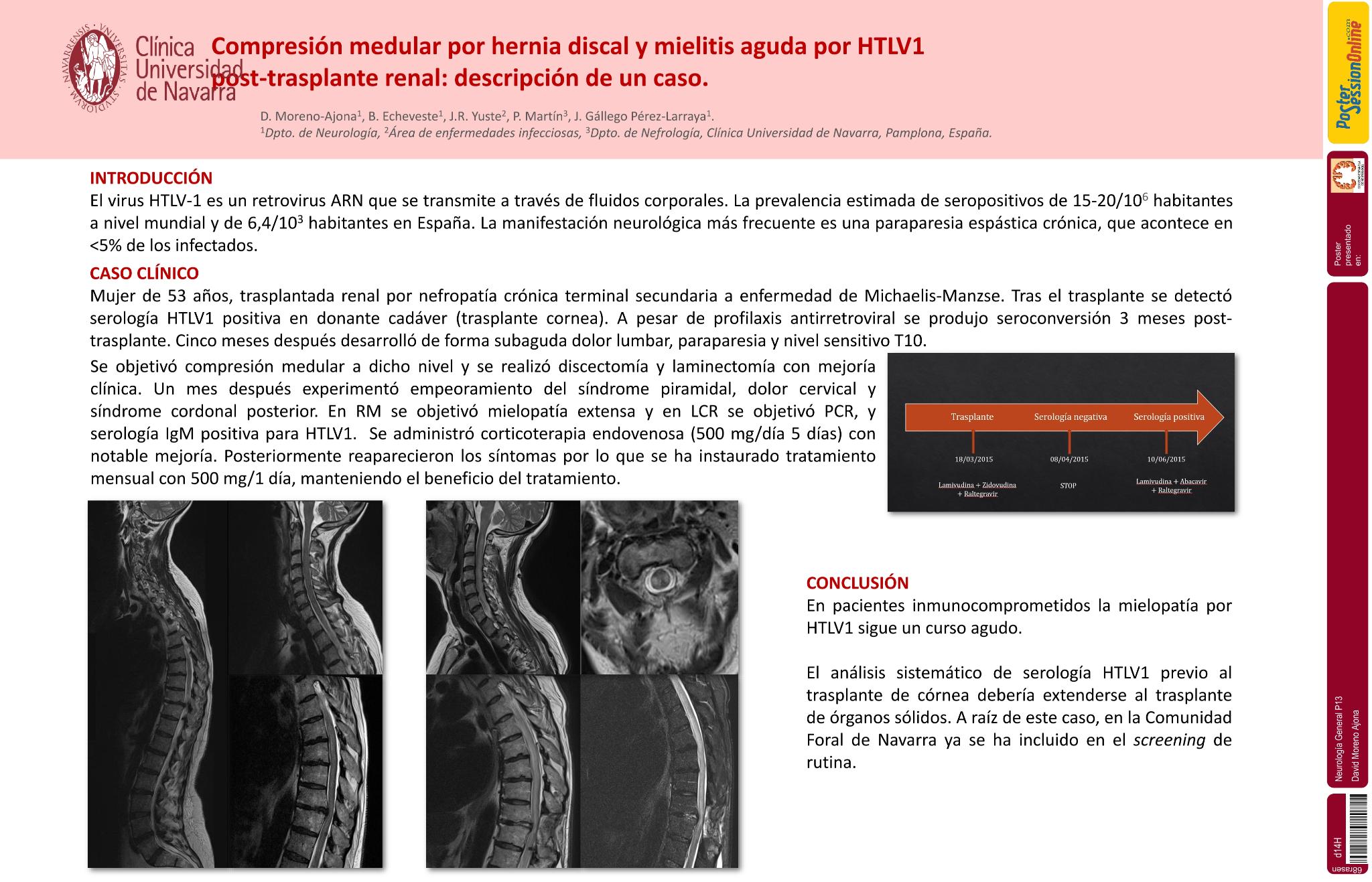 Compresión medular por hernia discal y mielitis aguda por HTLV1 post-trasplante renal: Descripción de un caso