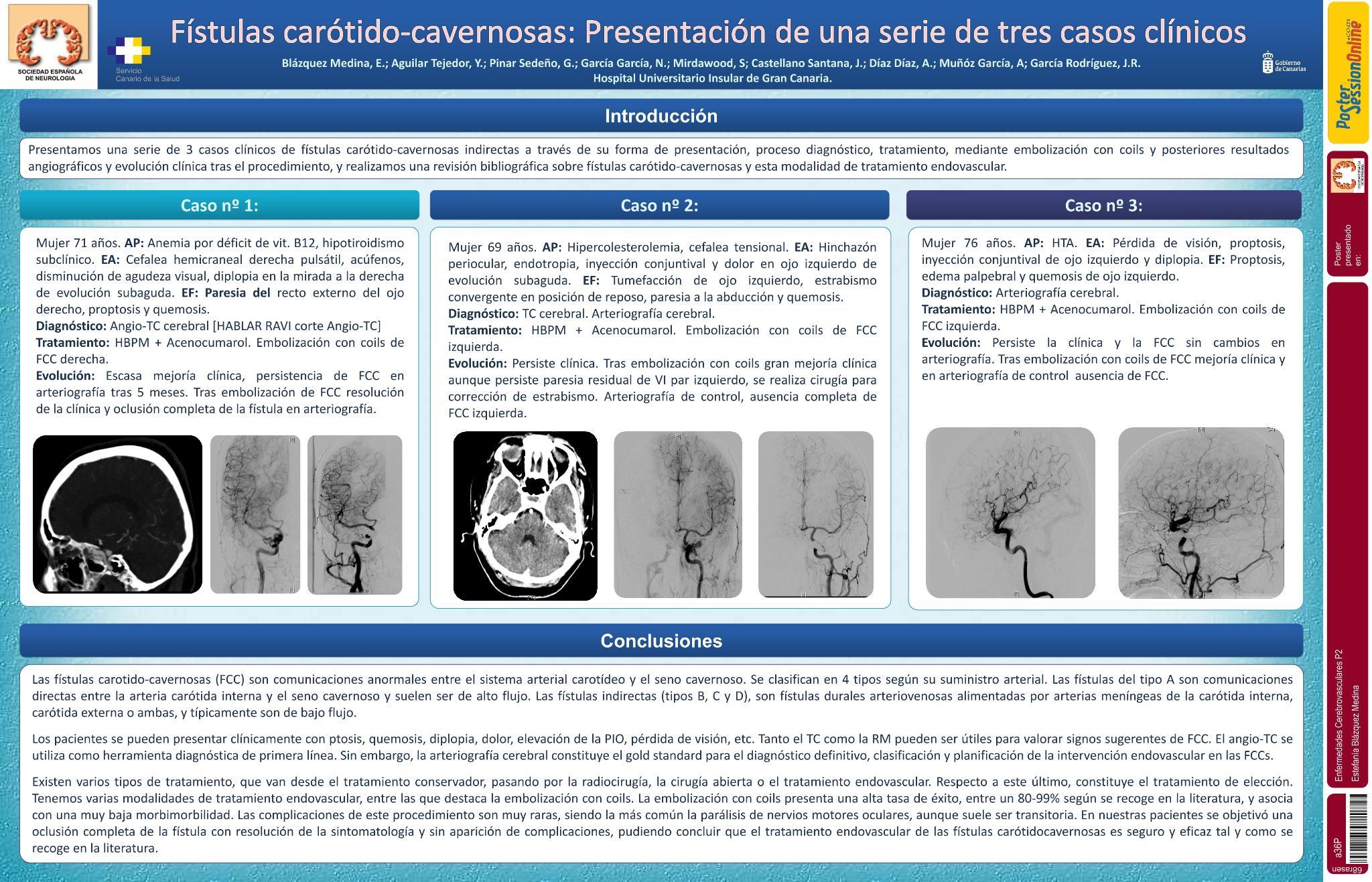 Fístulas carótido-cavernosas: Presentación de una serie de tres casos clínicos
