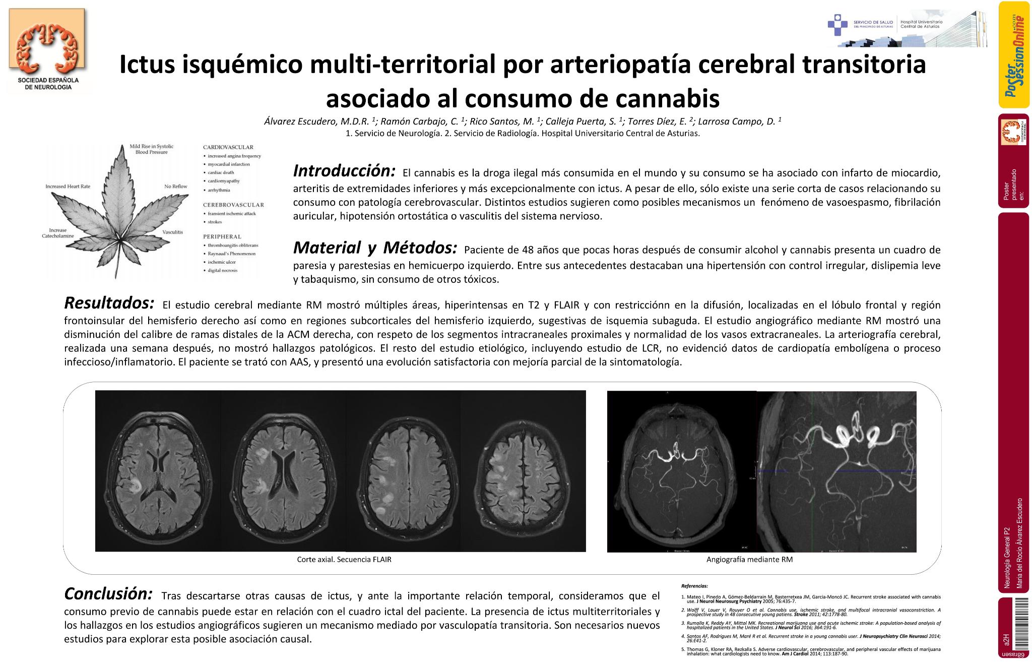Ictus isquémico multiterritorial por arteriopatía cerebral transitoria asociado al consumo de cannabis
