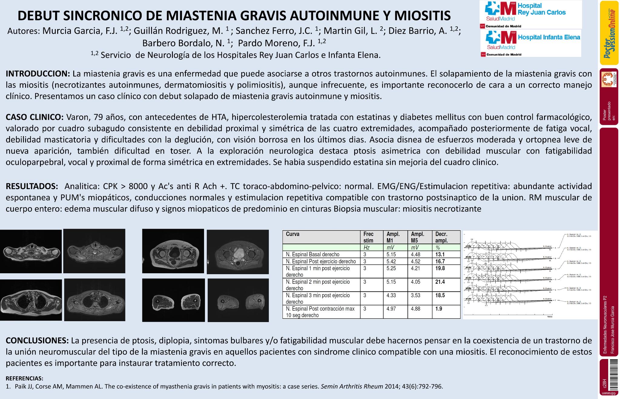 Debut sincrónico de miastenia gravis autoinmune y miositis