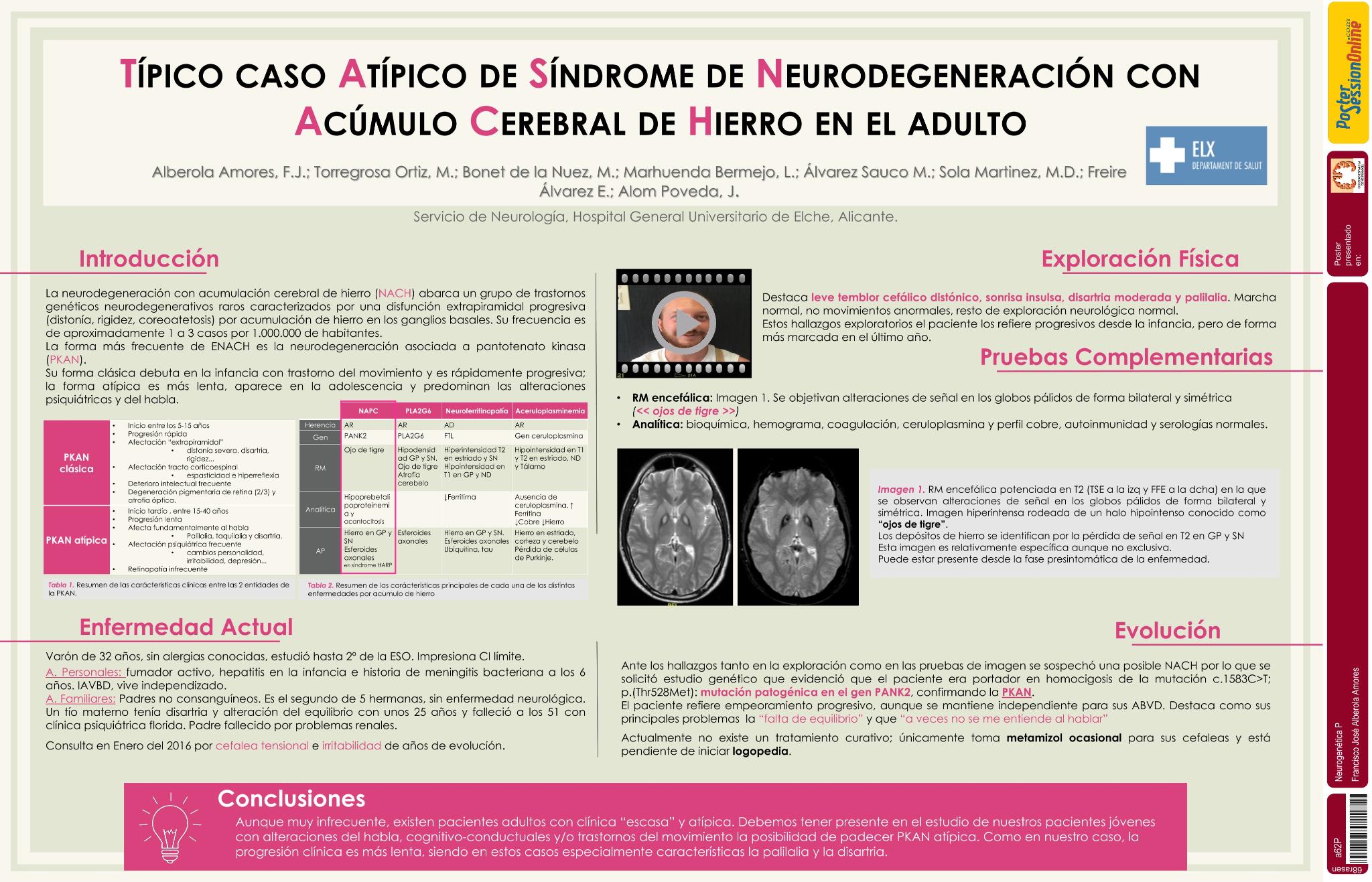 Típico caso atípico de Síndrome de Neurodegeneración con acúmulo cerebral de hierro en el adulto