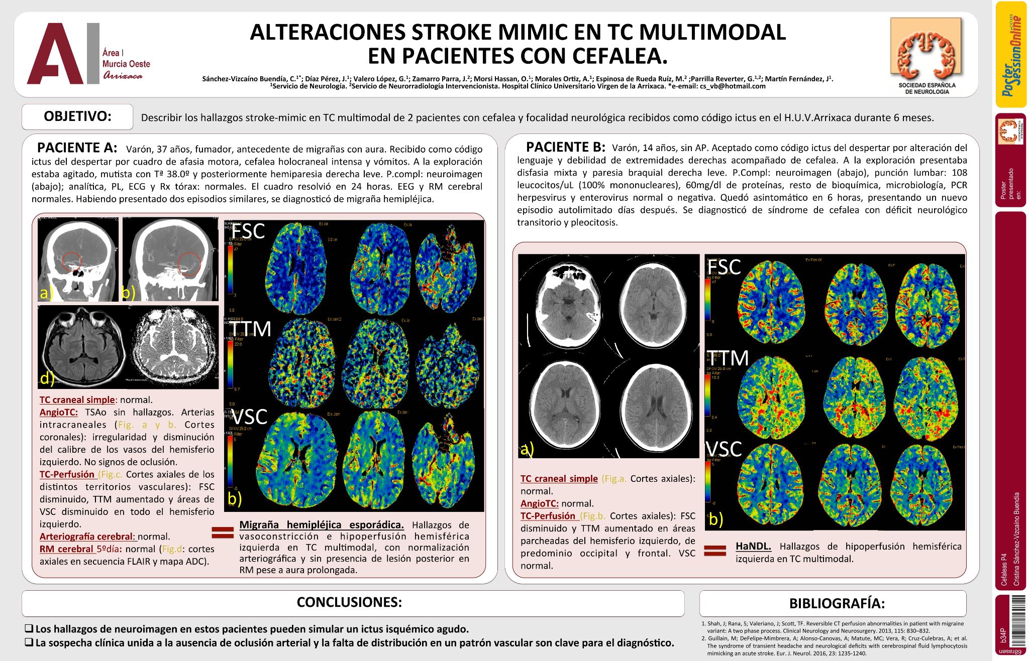 Alteraciones stroke mimick en TC multimodal en pacientes con cefalea