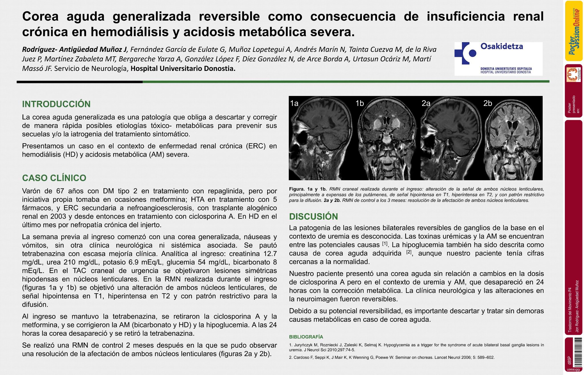 Corea aguda generalizada reversible como consecuencia de insuficiencia renal crónica en hemodiálisis y acidosis metabólica grave