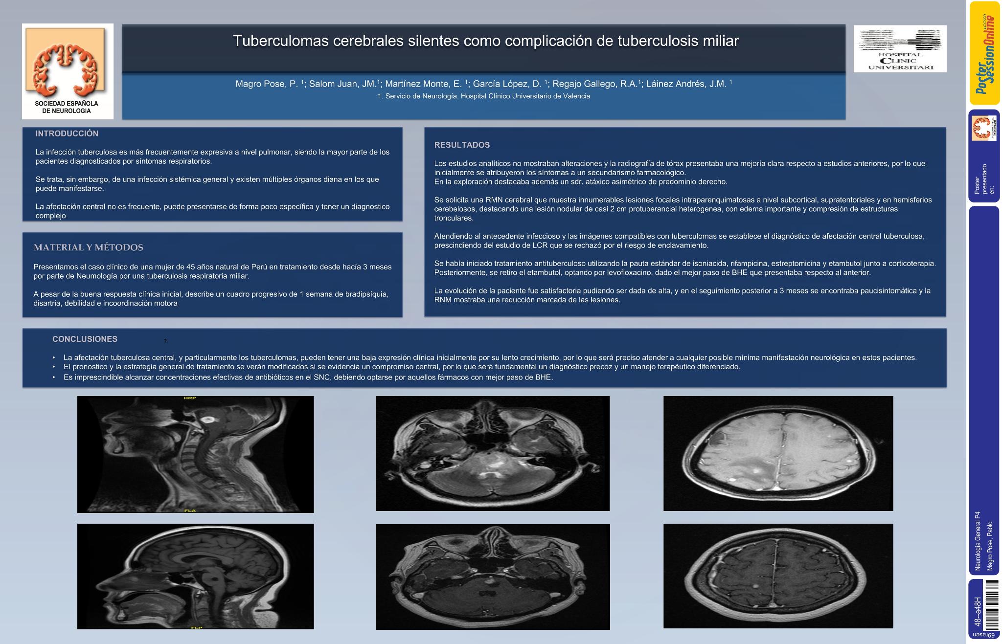 Tuberculomas cerebrales silentes como complicación de tuberculosis miliar